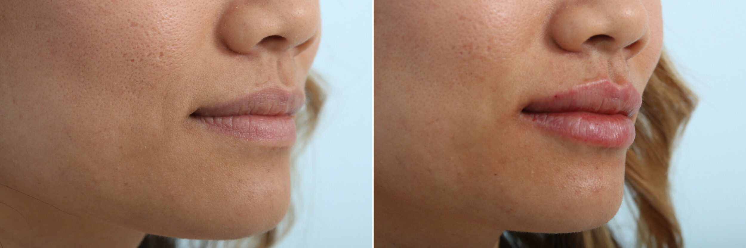Before and After Image: Lip Enhancement Before and After Photos in Houston, TX, Patient 9427 - right-front-oblique