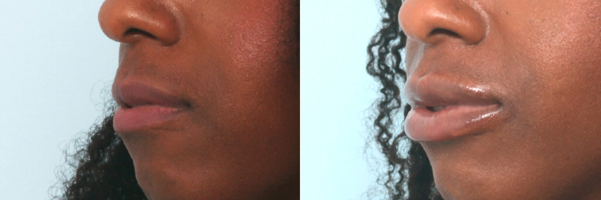 Before and After Image: Lip Enhancement Before and After Photos in Houston, TX, Patient 10093 - left-front-oblique