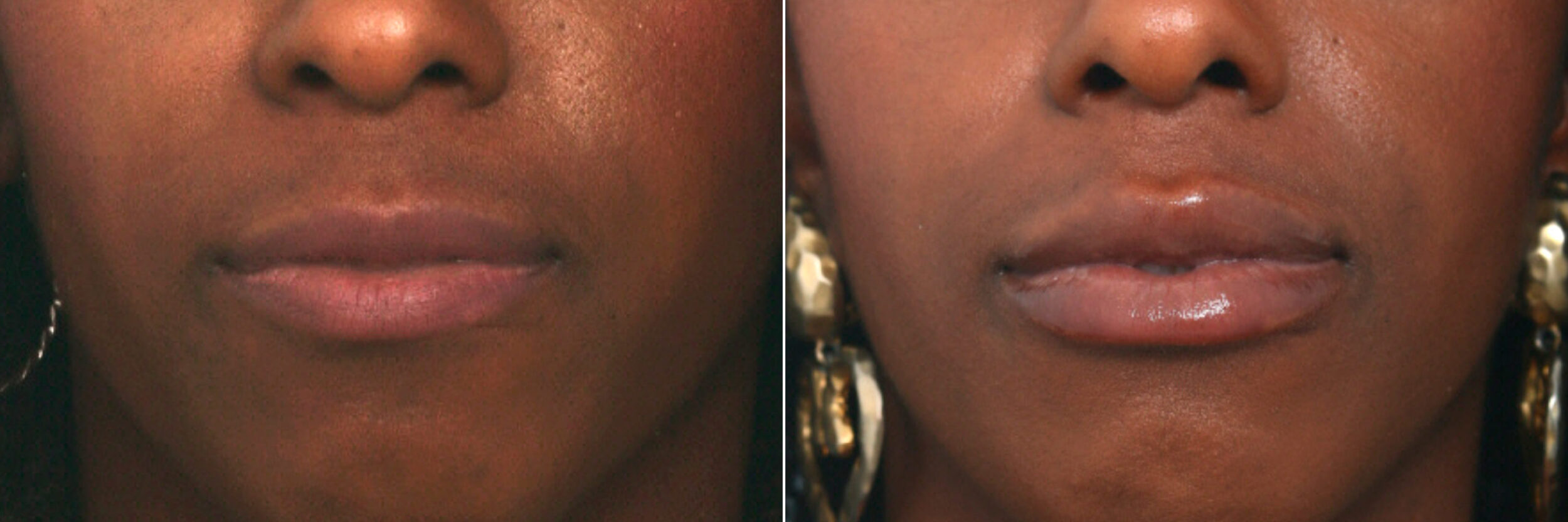 Before and After Image: Lip Enhancement Before and After Photos in Houston, TX, Patient 10093 - front