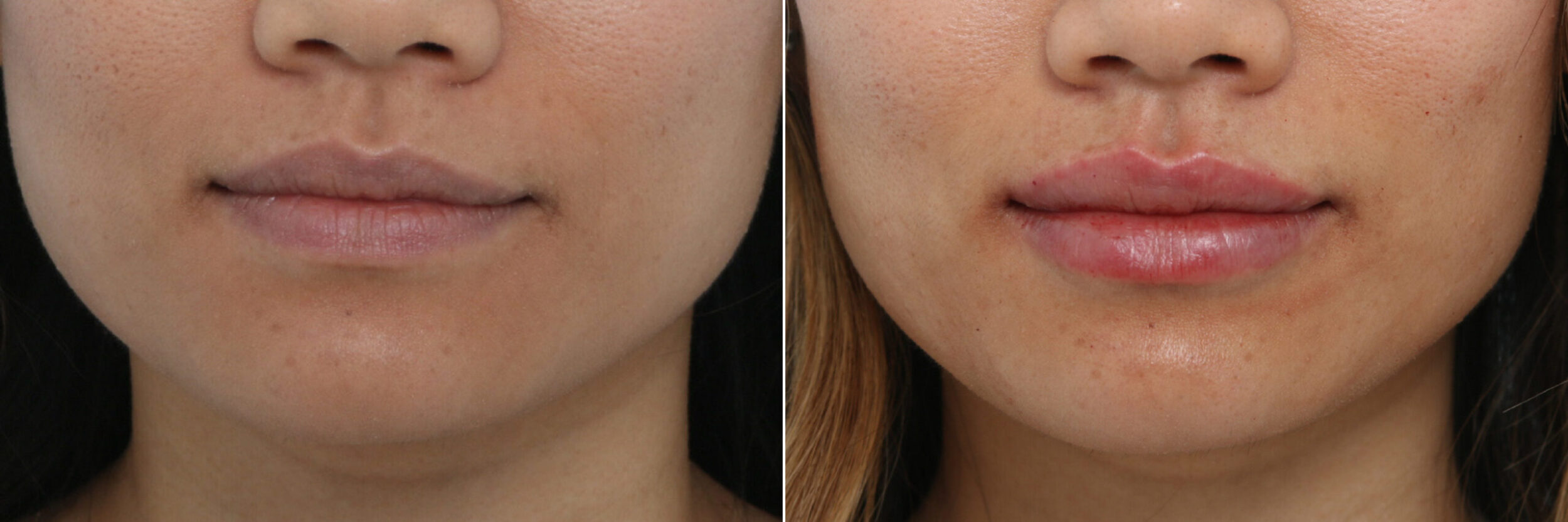 Before and After Image: Lip Enhancement Before and After Photos in Houston, TX, Patient 9427 - front