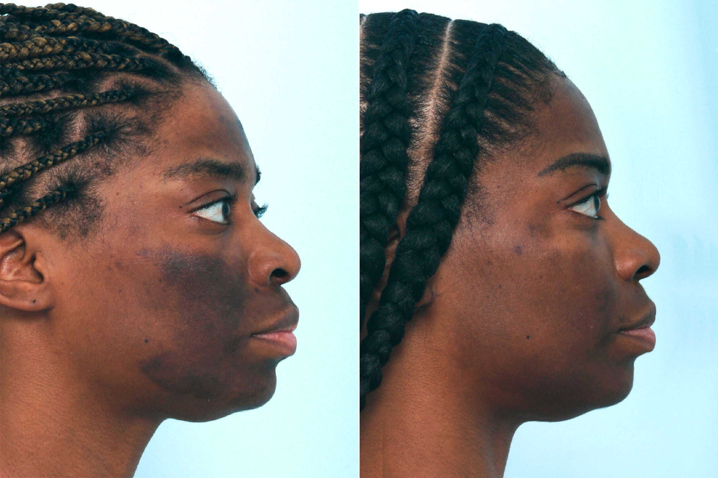 Before and After Image: Chemical Peels Before and After Photos in Houston, TX, Patient 10039 - right-side