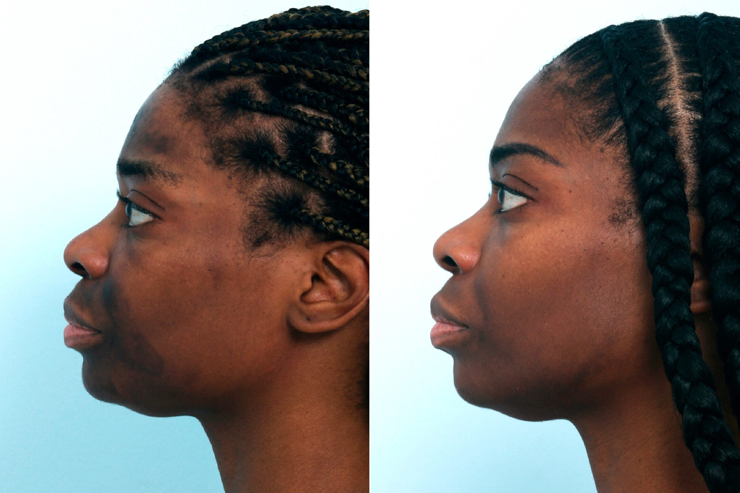Before and After Image: Chemical Peels Before and After Photos in Houston, TX, Patient 10039 - left-side