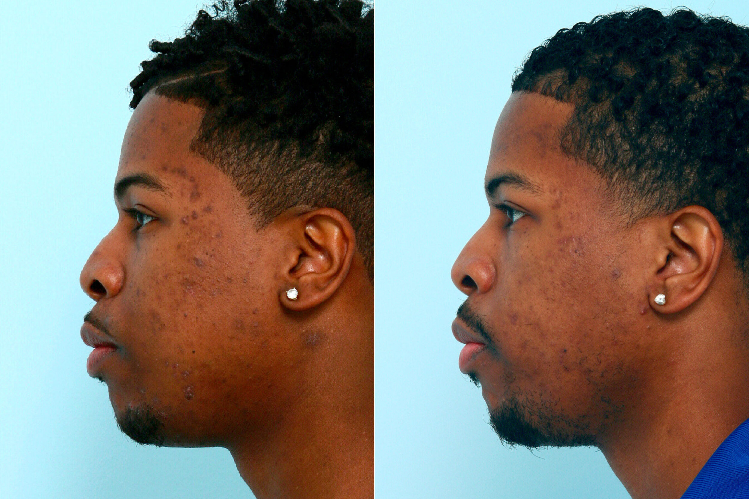Before and After Image: Chemical Peels Before and After Photos in Houston, TX, Patient 10061 - left-side