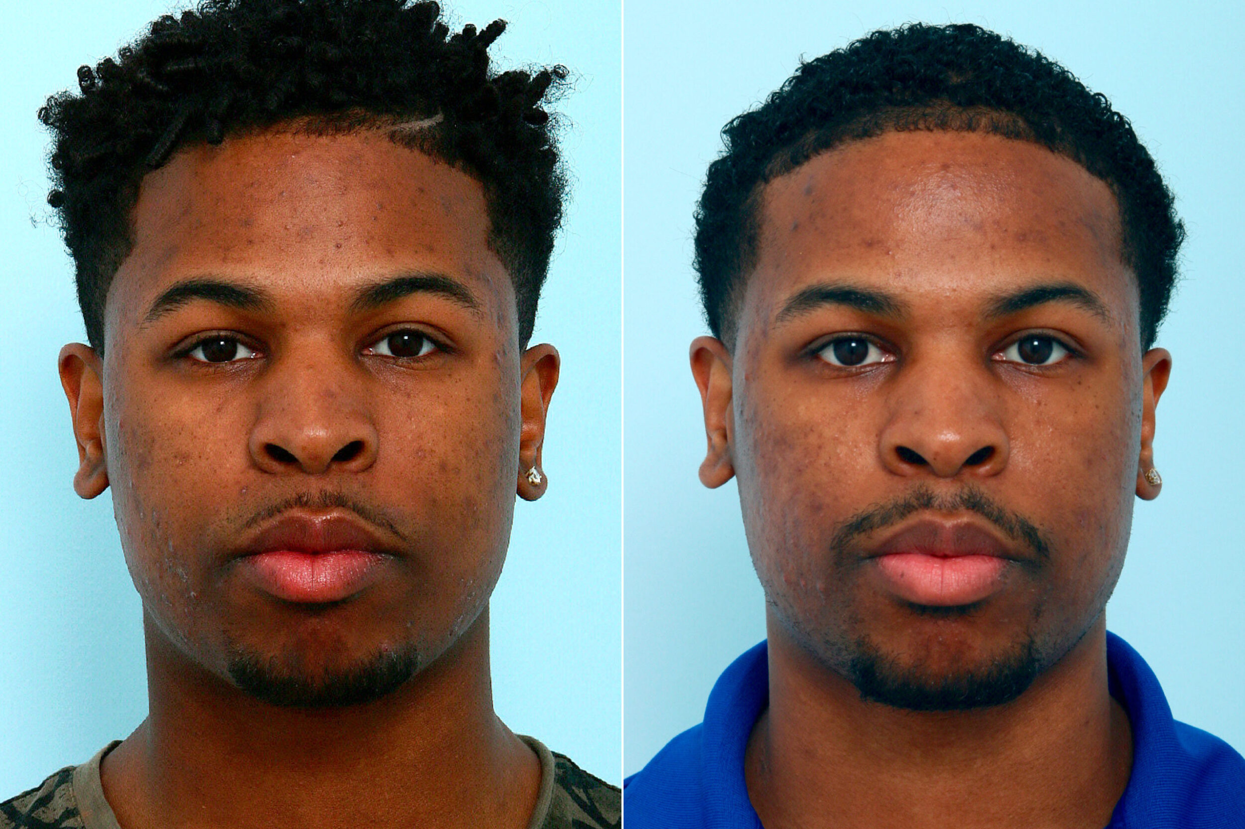 Before and After Image: Chemical Peels Before and After Photos in Houston, TX, Patient 10061 - front