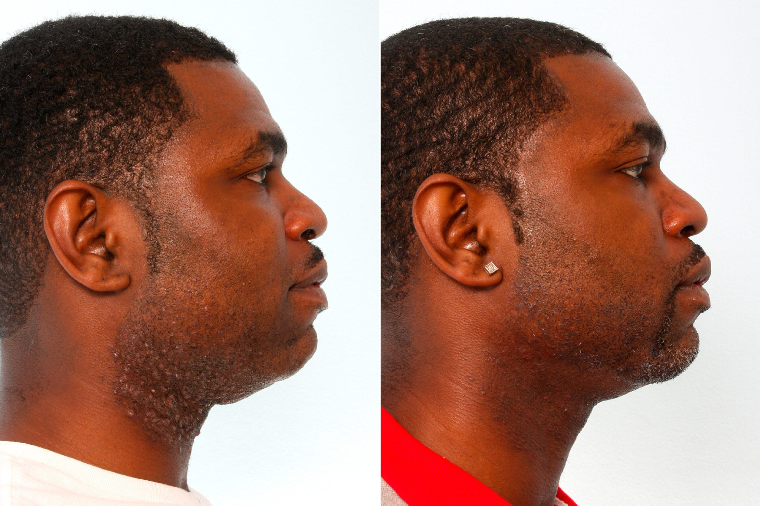 Before and After Image: Laser Hair Removal Before and After Photos in Houston, TX, Patient 10171 - right-side