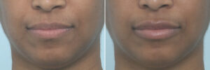 patient 10259 lip enhancement before after 6