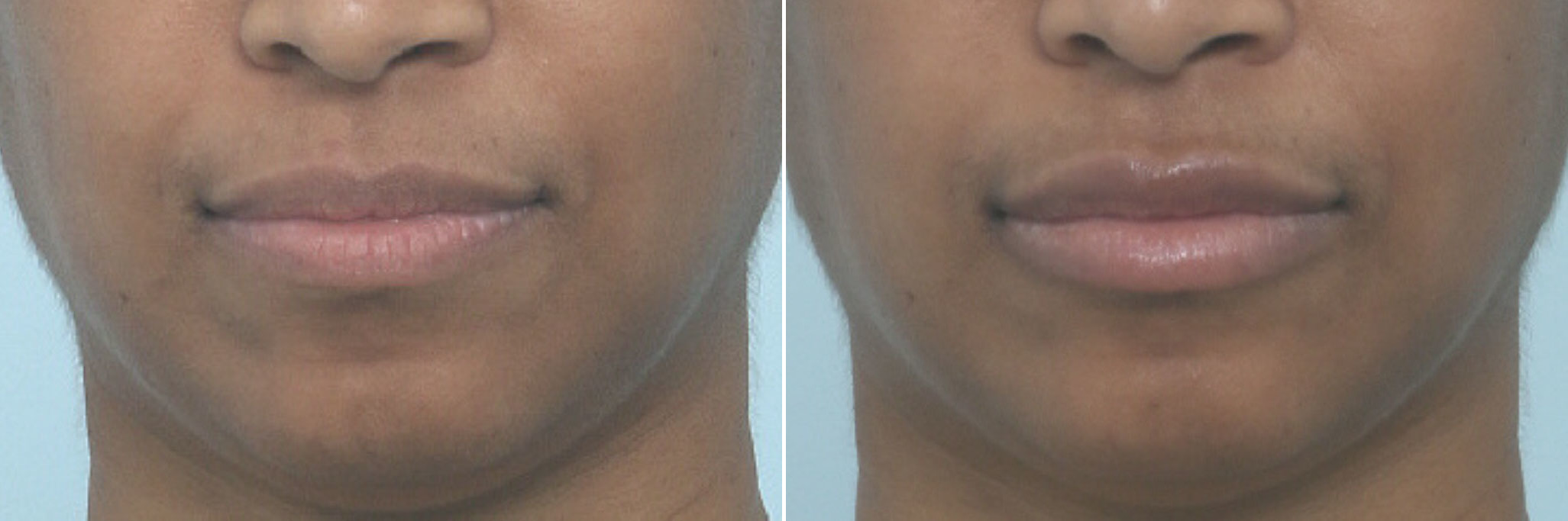 Before and After Image: Lip Enhancement Before and After Photos in Houston, TX, Patient 10259 - front