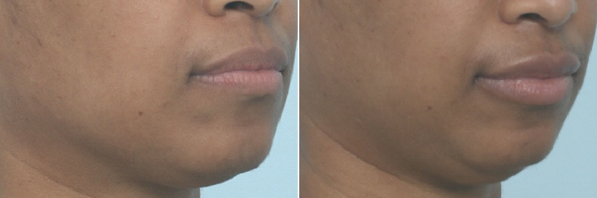 Before and After Image: Lip Enhancement Before and After Photos in Houston, TX, Patient 10259 - right-front-oblique