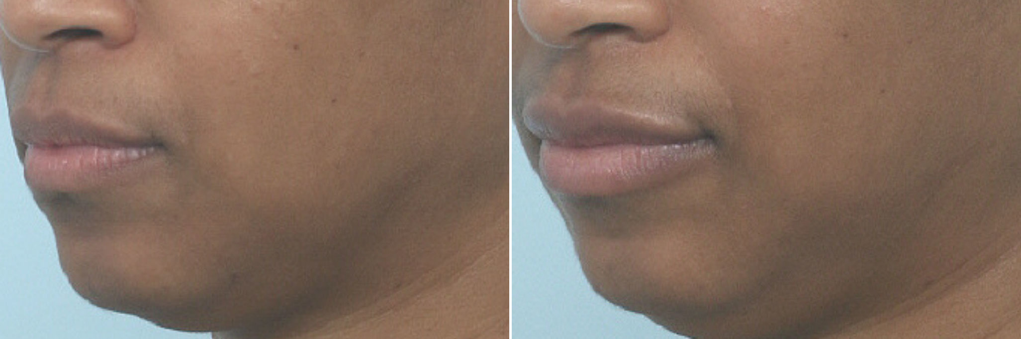 Before and After Image: Lip Enhancement Before and After Photos in Houston, TX, Patient 10259 - left-front-oblique