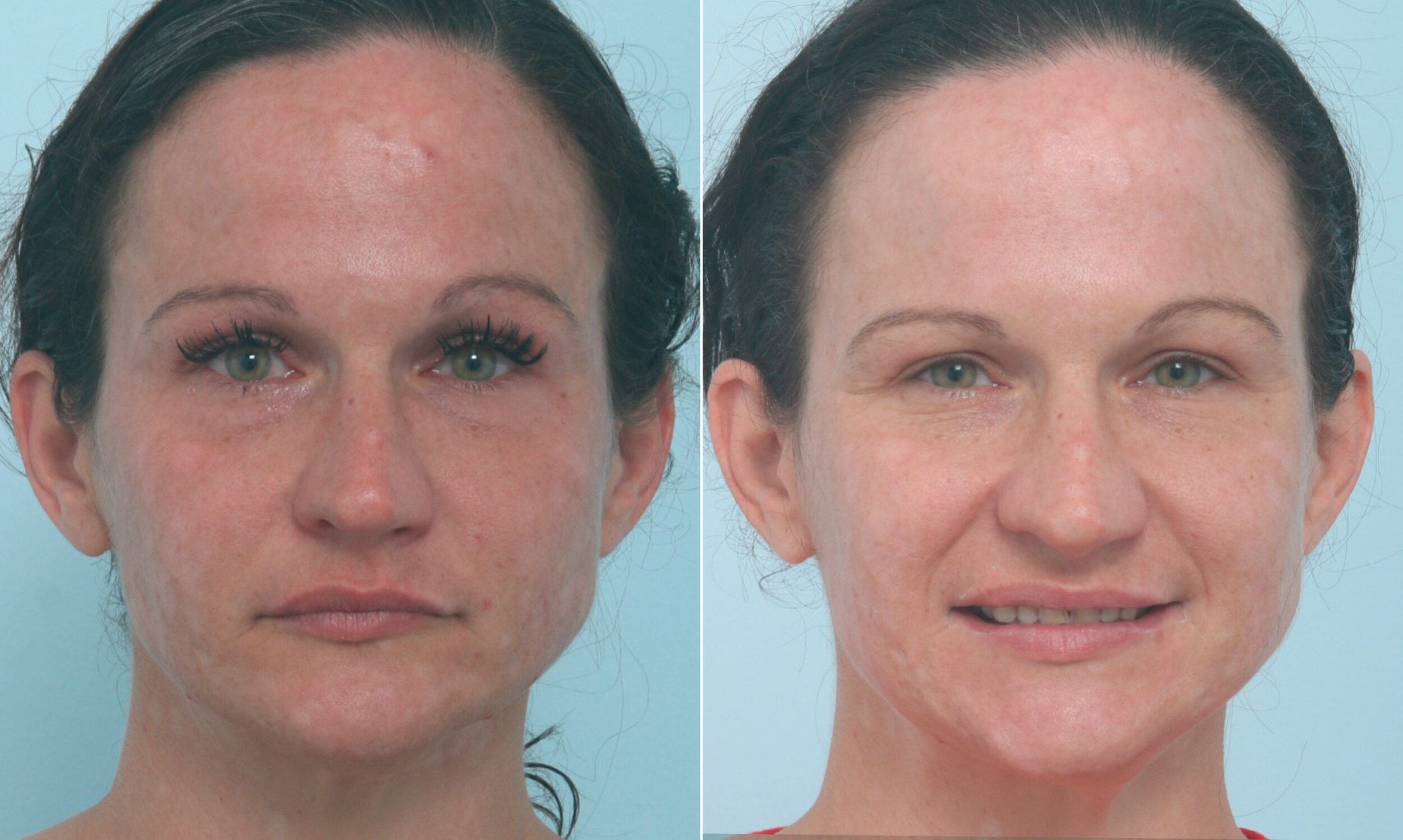 Before and After Image: Fraxel Laser Before and After Photos in Houston, TX, Patient 10321 - front