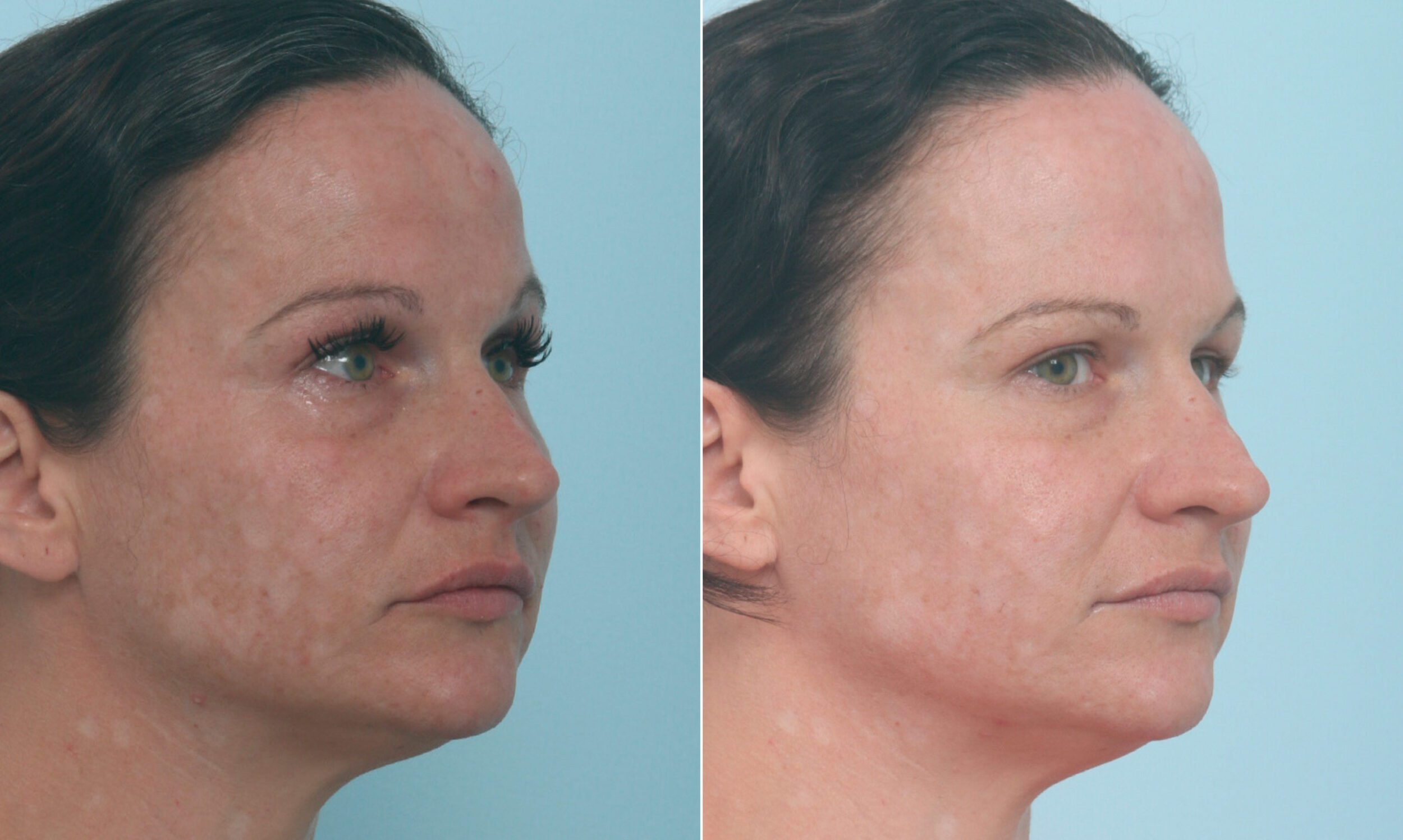 Before and After Image: Fraxel Laser Before and After Photos in Houston, TX, Patient 10321 - right-front-oblique