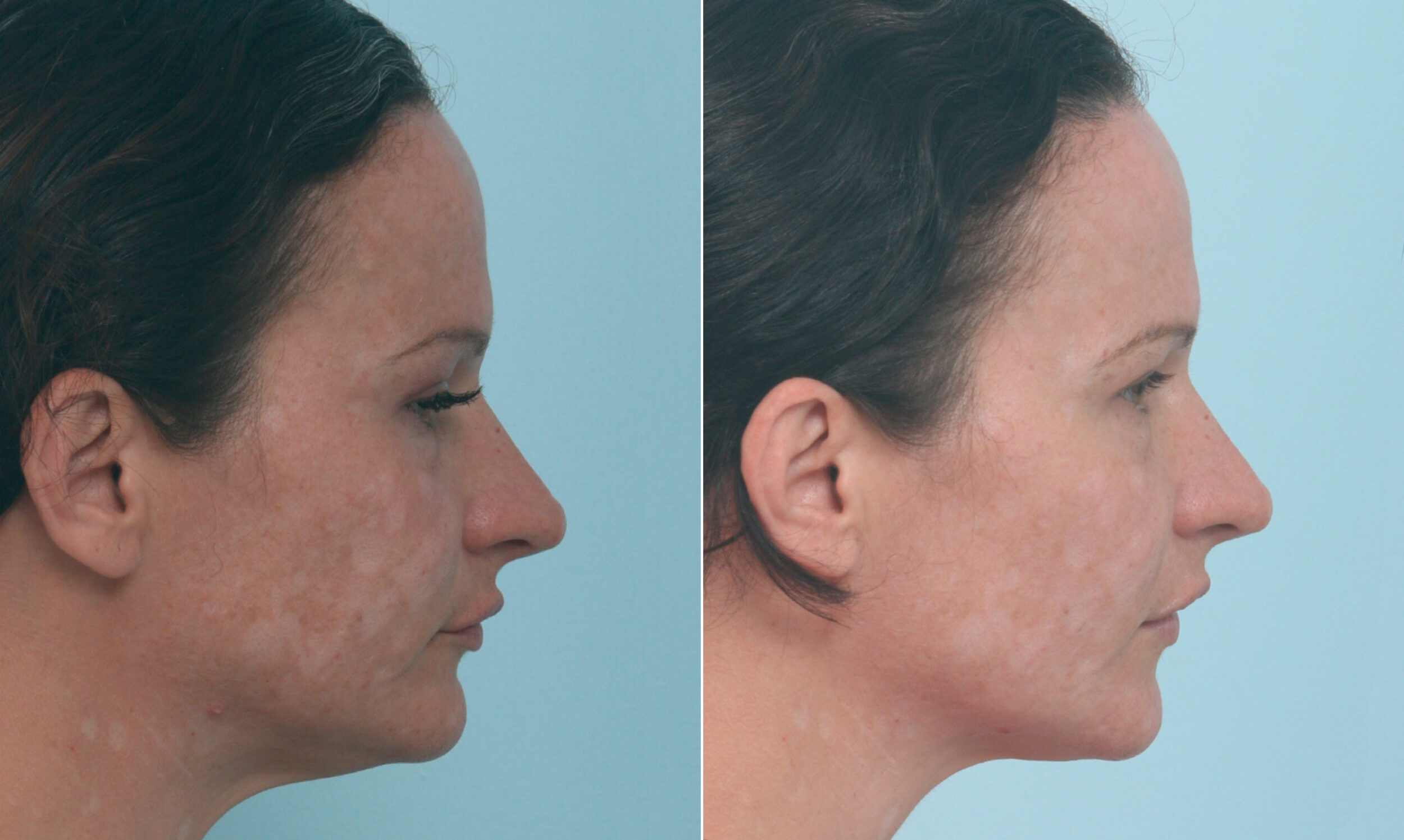 Before and After Image: Fraxel Laser Before and After Photos in Houston, TX, Patient 10321 - right-side