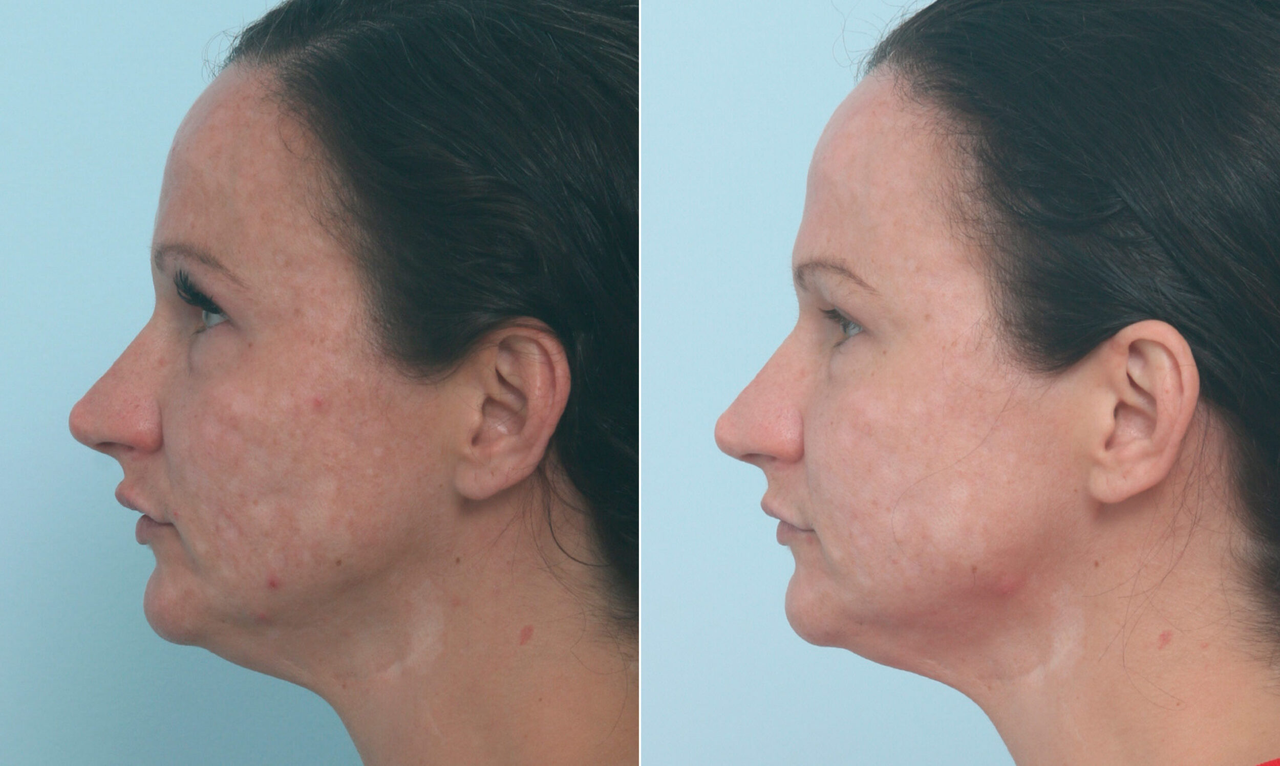 Before and After Image: Fraxel Laser Before and After Photos in Houston, TX, Patient 10321 - left-side