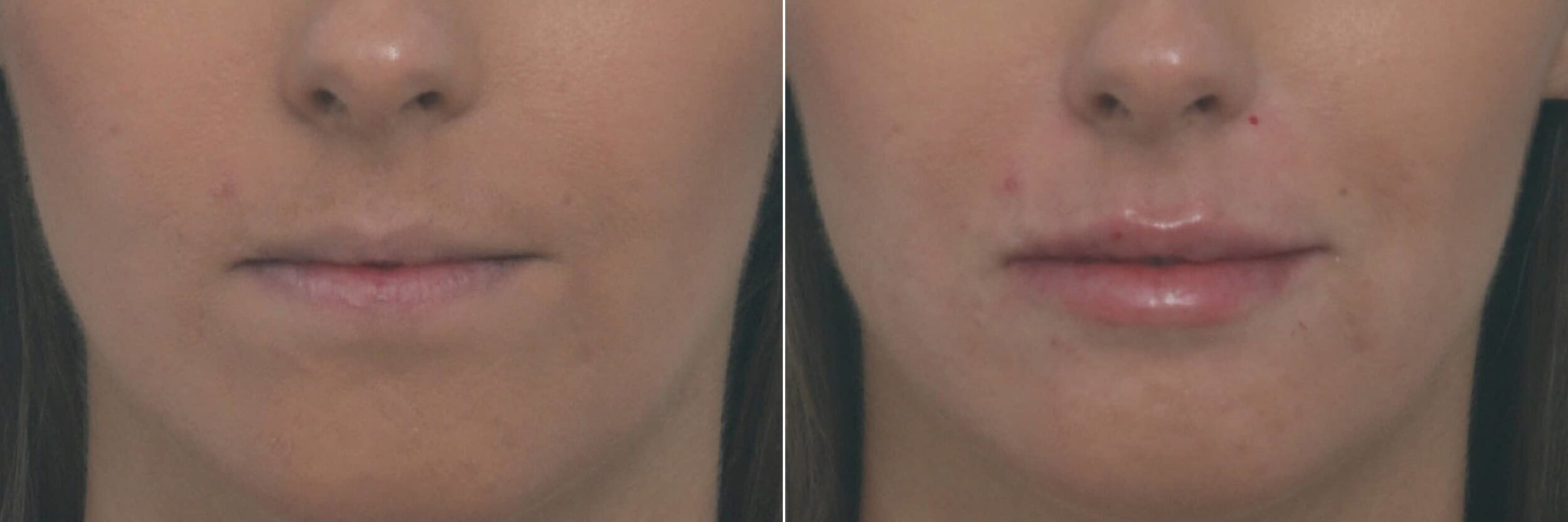 Before and After Image: Lip Enhancement Before and After Photos in Houston, TX, Patient 10478 - front