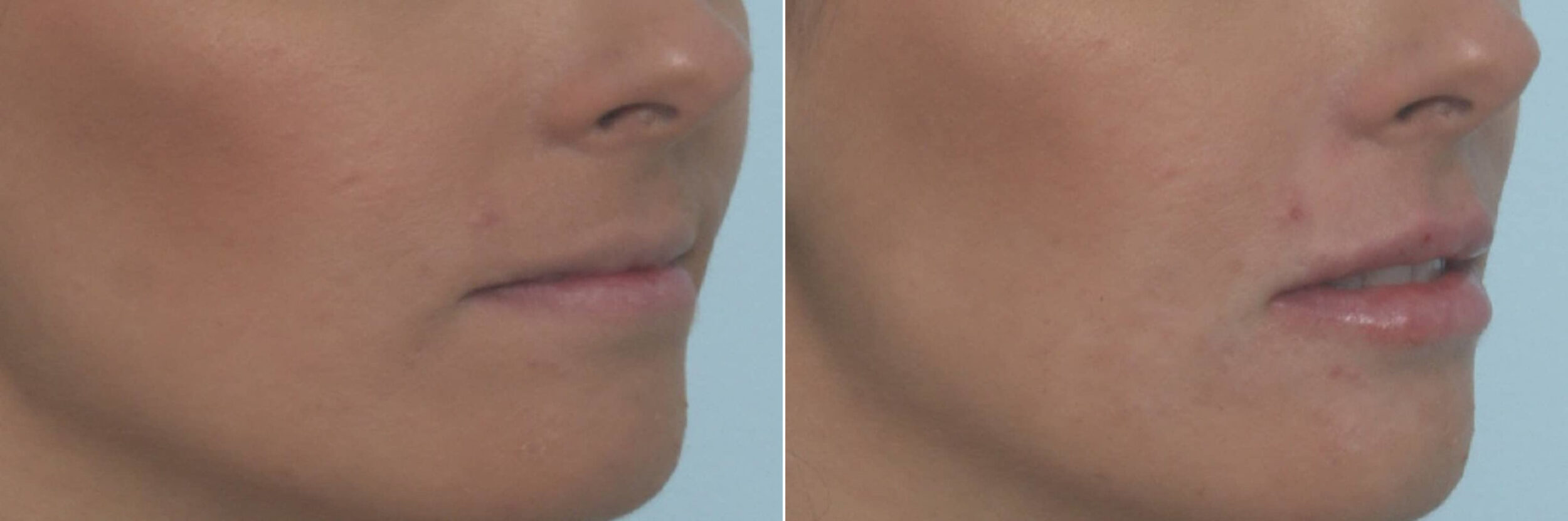 Before and After Image: Lip Enhancement Before and After Photos in Houston, TX, Patient 10478 - right-front-oblique