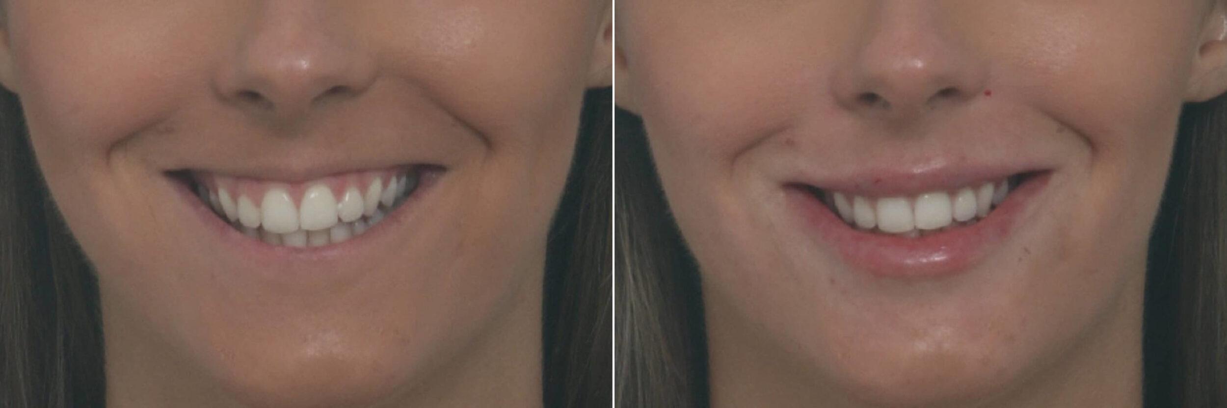 Before and After Image: Lip Enhancement Before and After Photos in Houston, TX, Patient 10478 - front