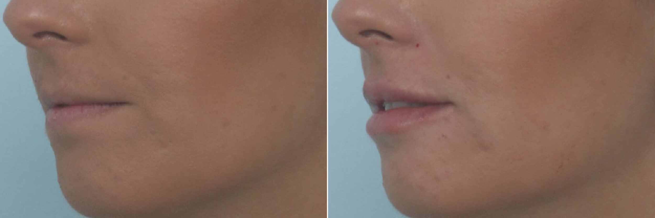 Before and After Image: Lip Enhancement Before and After Photos in Houston, TX, Patient 10478 - left-front-oblique