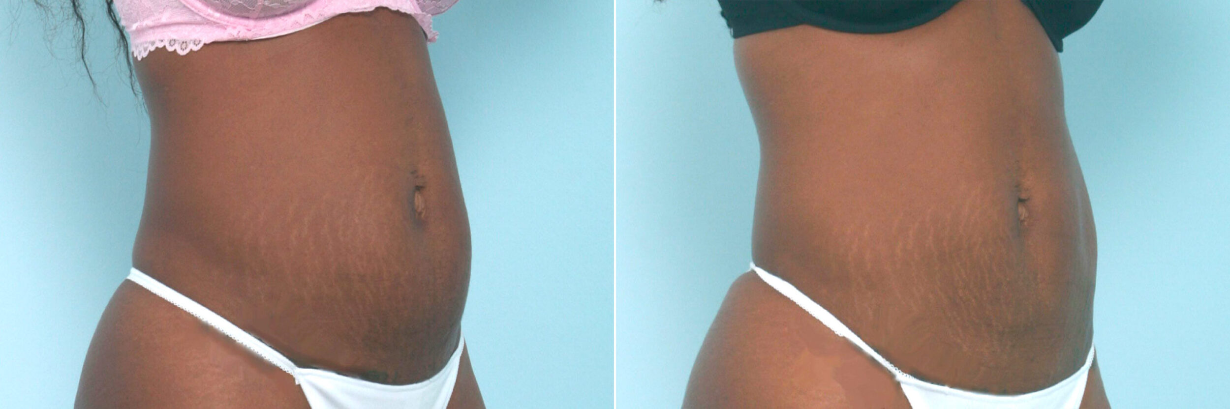 Before and After Image: CoolSculpting Before and After Photos in Houston, TX, Patient 10539 - right-front-oblique