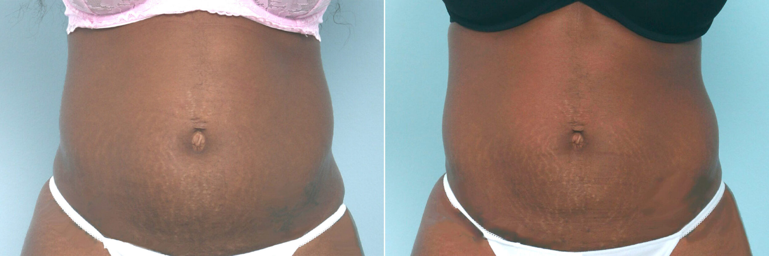 Before and After Image: CoolSculpting Before and After Photos in Houston, TX, Patient 10539 - front