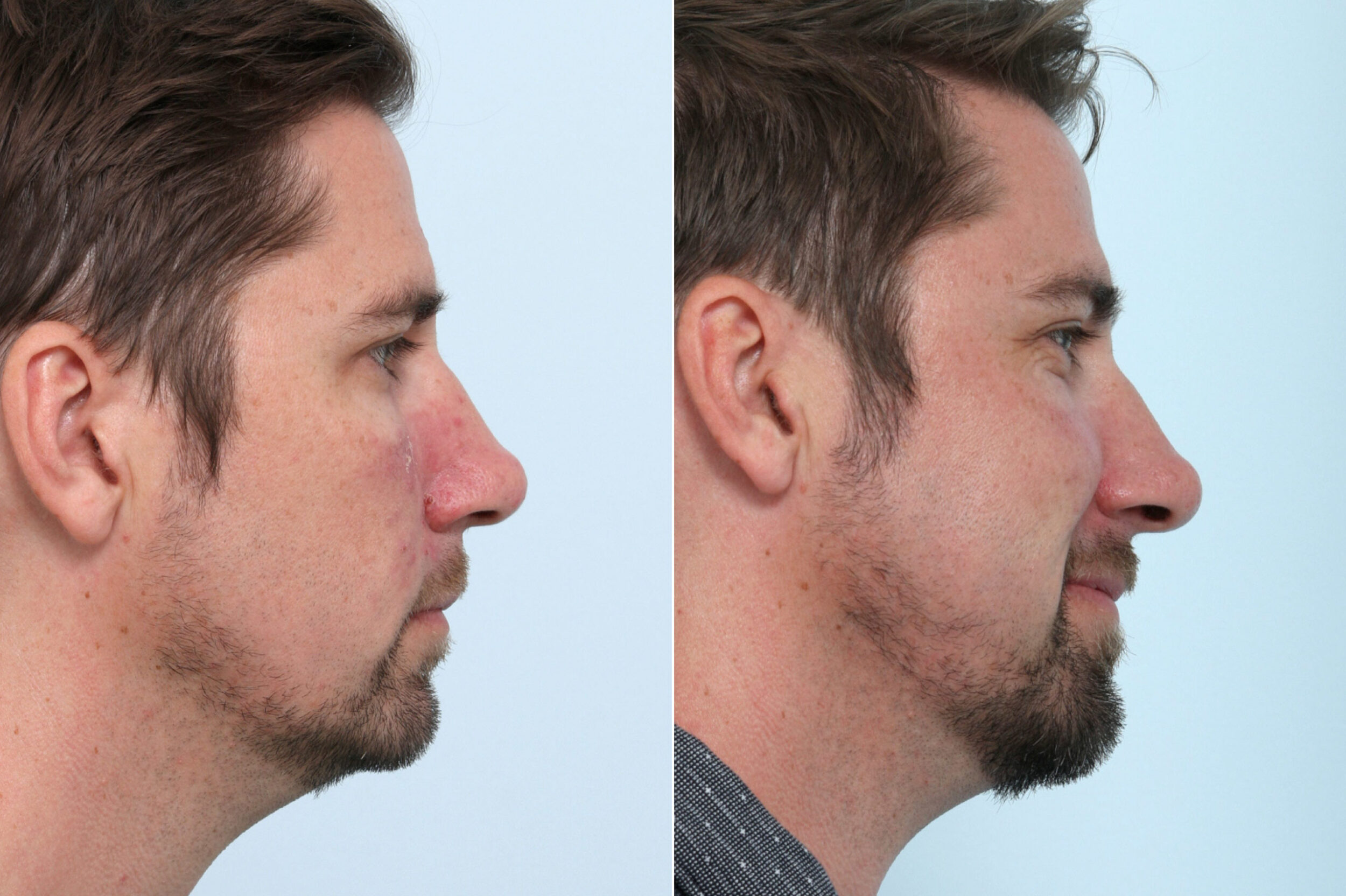 Before and After Image: Laser Genesis Before and After Photos in Houston, TX, Patient 10660 - right-side