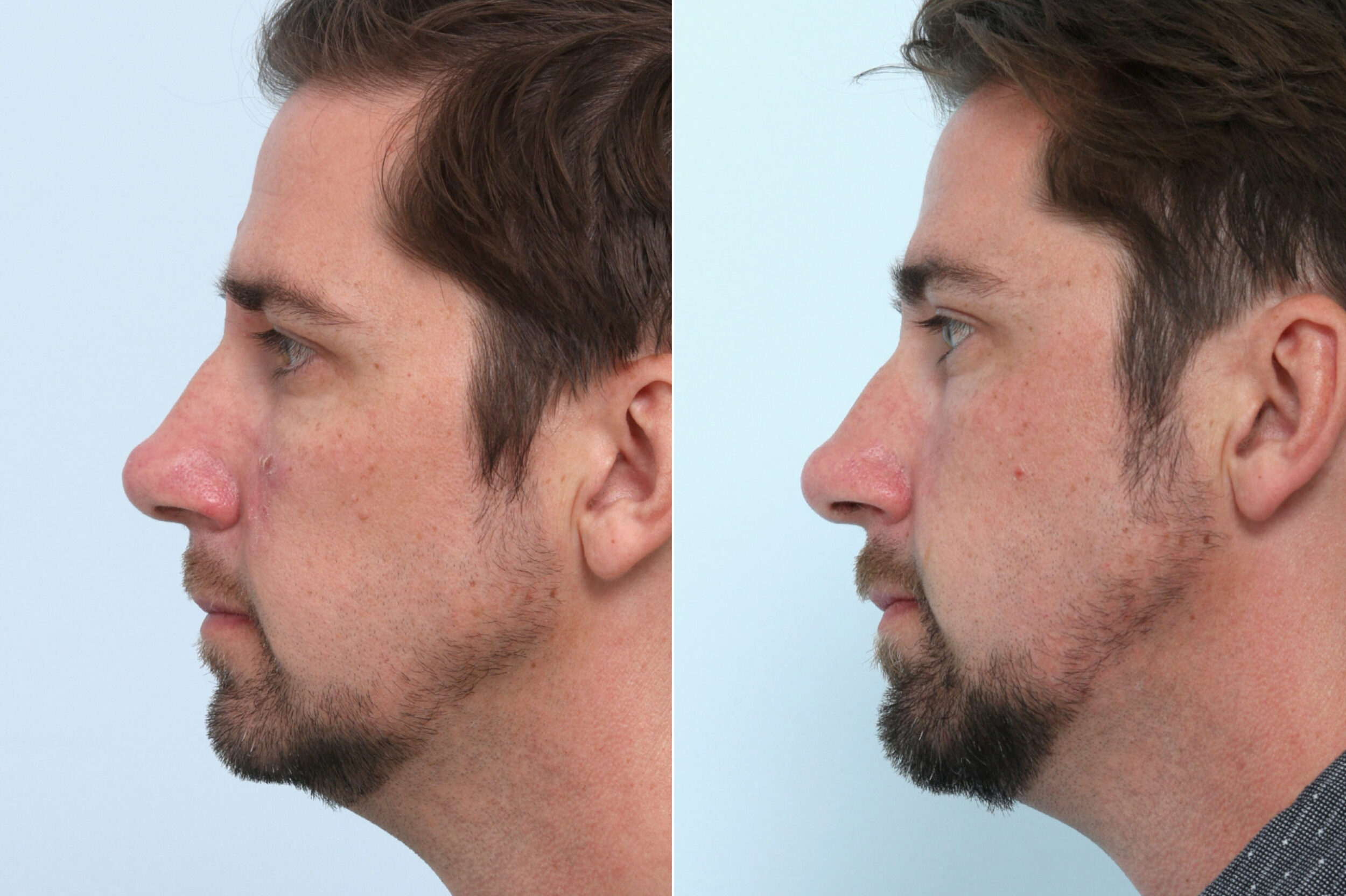 Before and After Image: Laser Genesis Before and After Photos in Houston, TX, Patient 10660 - left-side