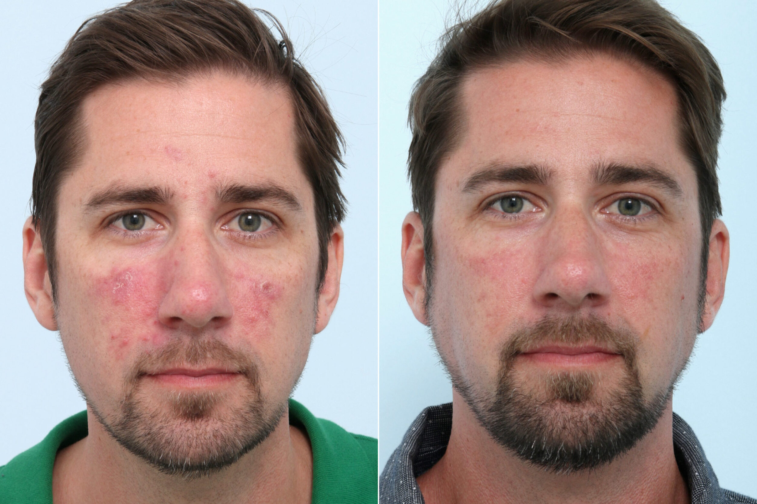 Before and After Image: Laser Genesis Before and After Photos in Houston, TX, Patient 10660 - front
