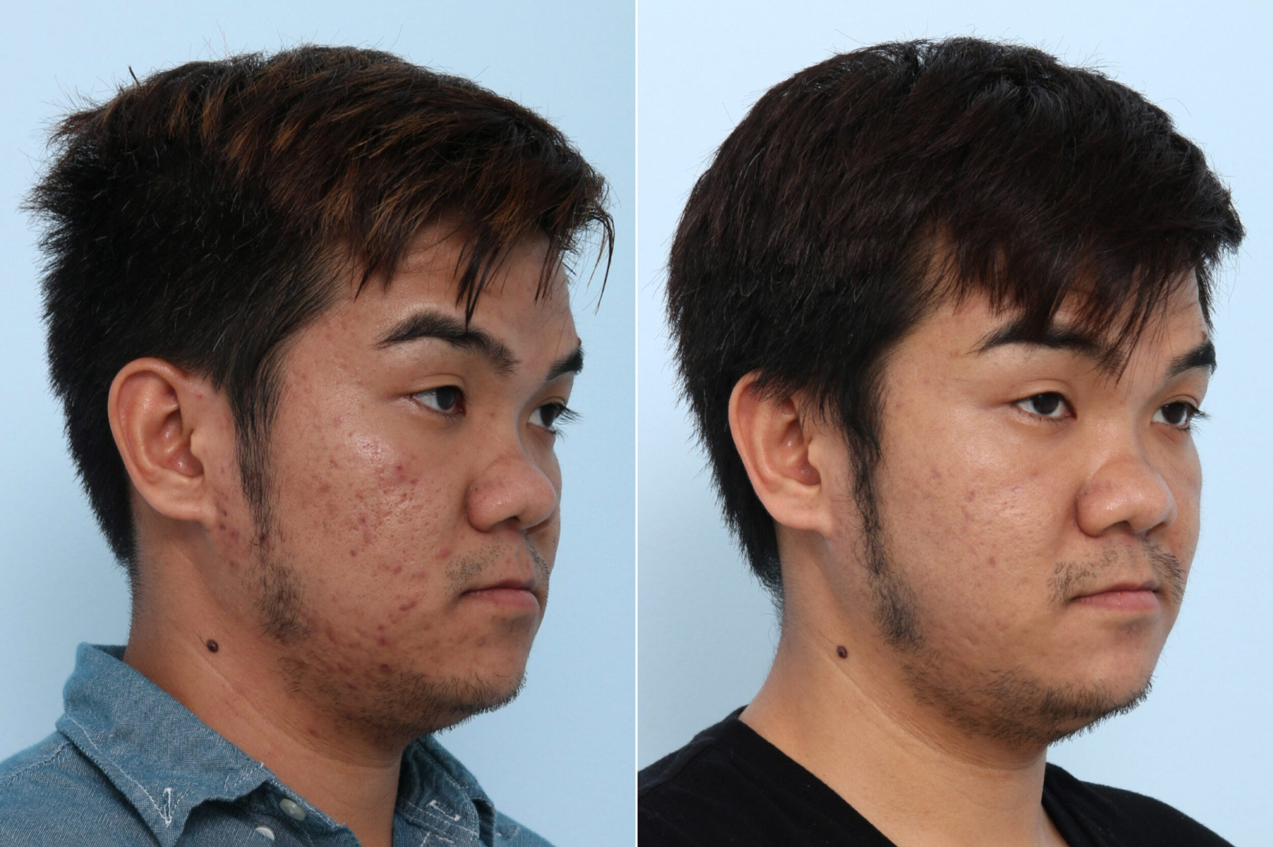 Before and After Image: Fraxel Laser Before and After Photos in Houston, TX, Patient 10754 - right-front-oblique