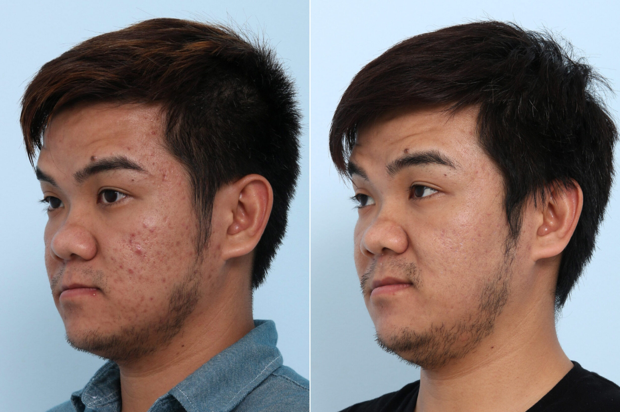 Before and After Image: Fraxel Laser Before and After Photos in Houston, TX, Patient 10754 - left-front-oblique