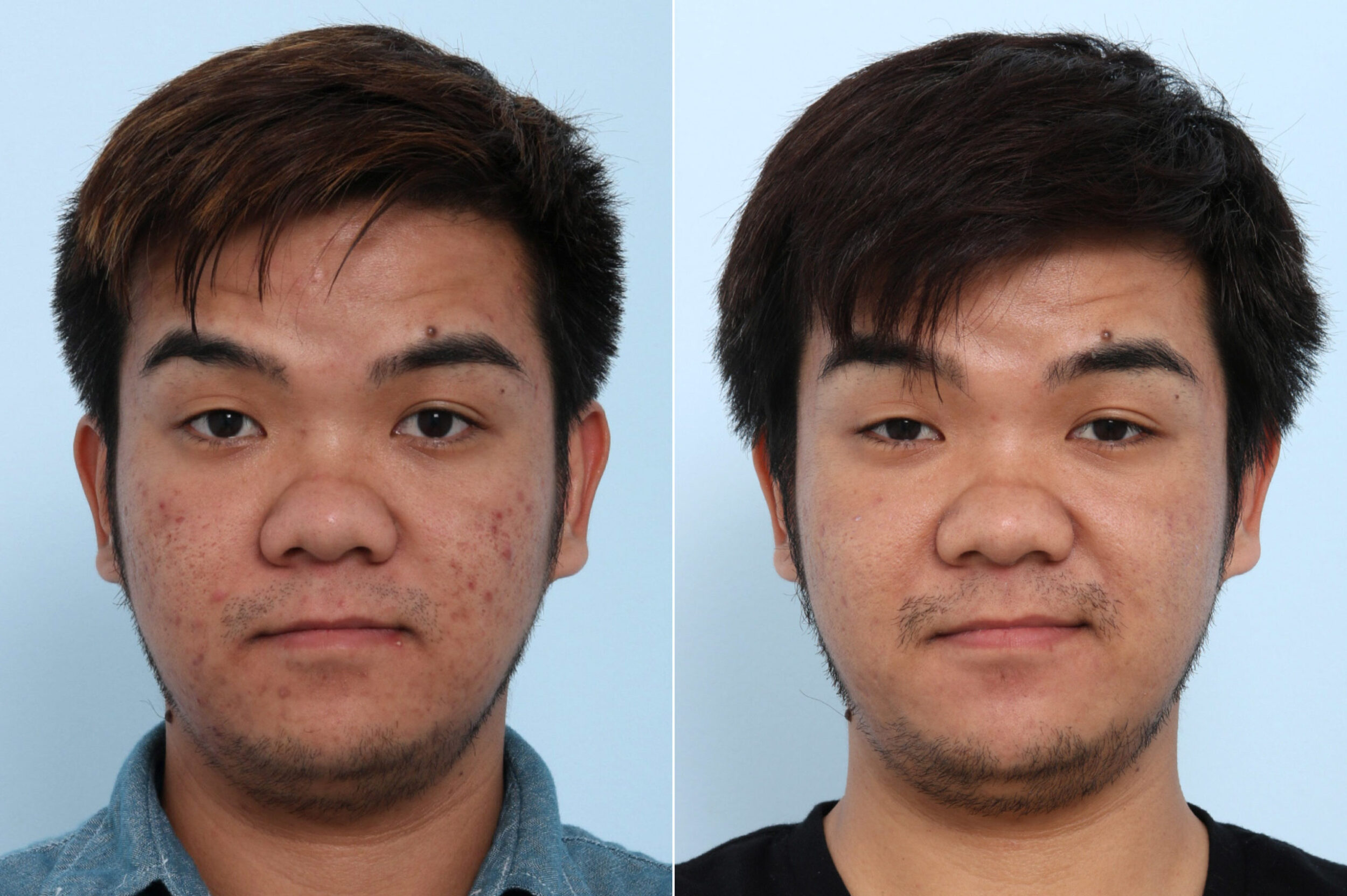 Before and After Image: Fraxel Laser Before and After Photos in Houston, TX, Patient 10754 - front