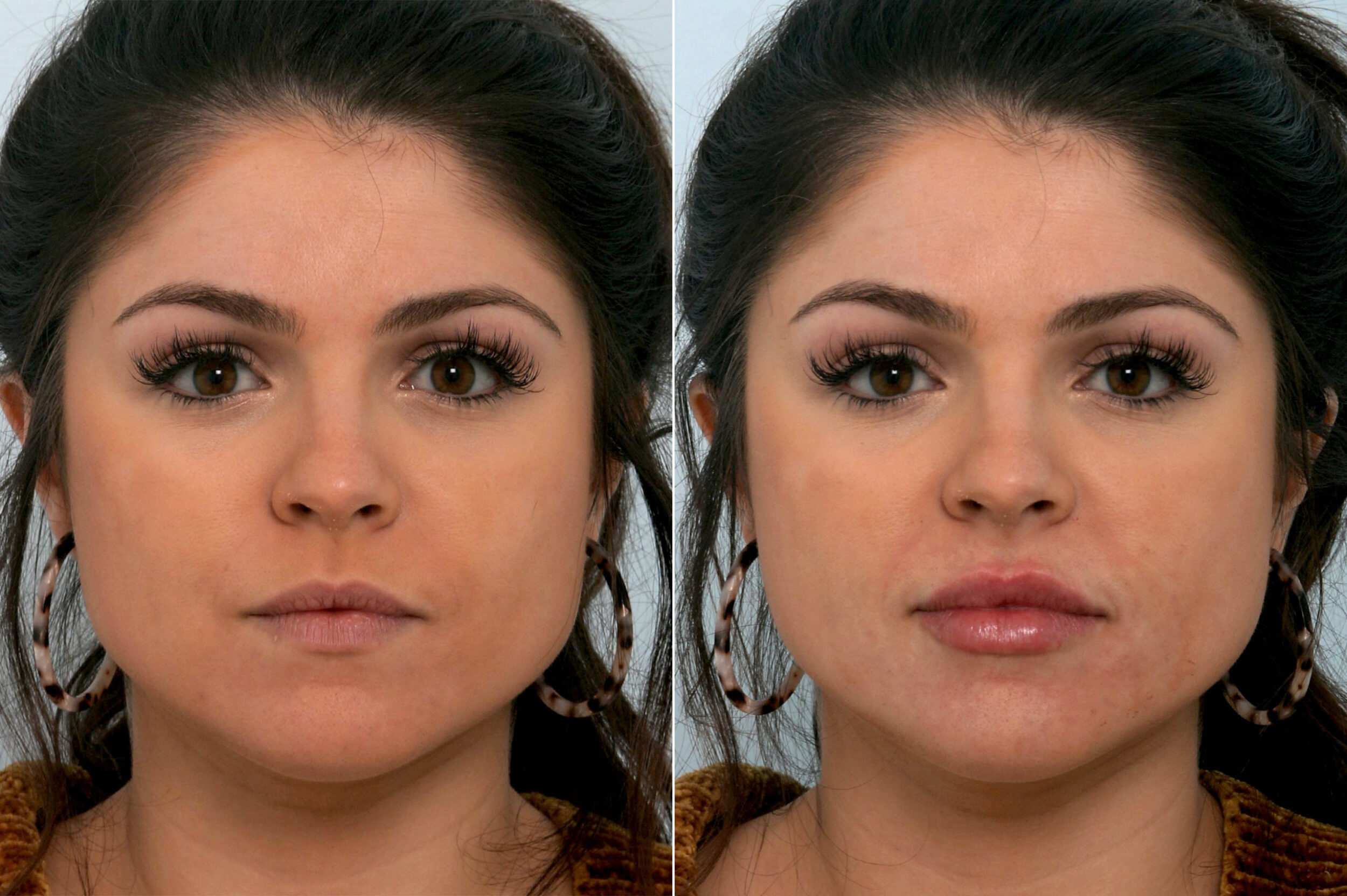 Before and After Image: Fillers Before and After Photos in Houston, TX, Patient 10755 - front