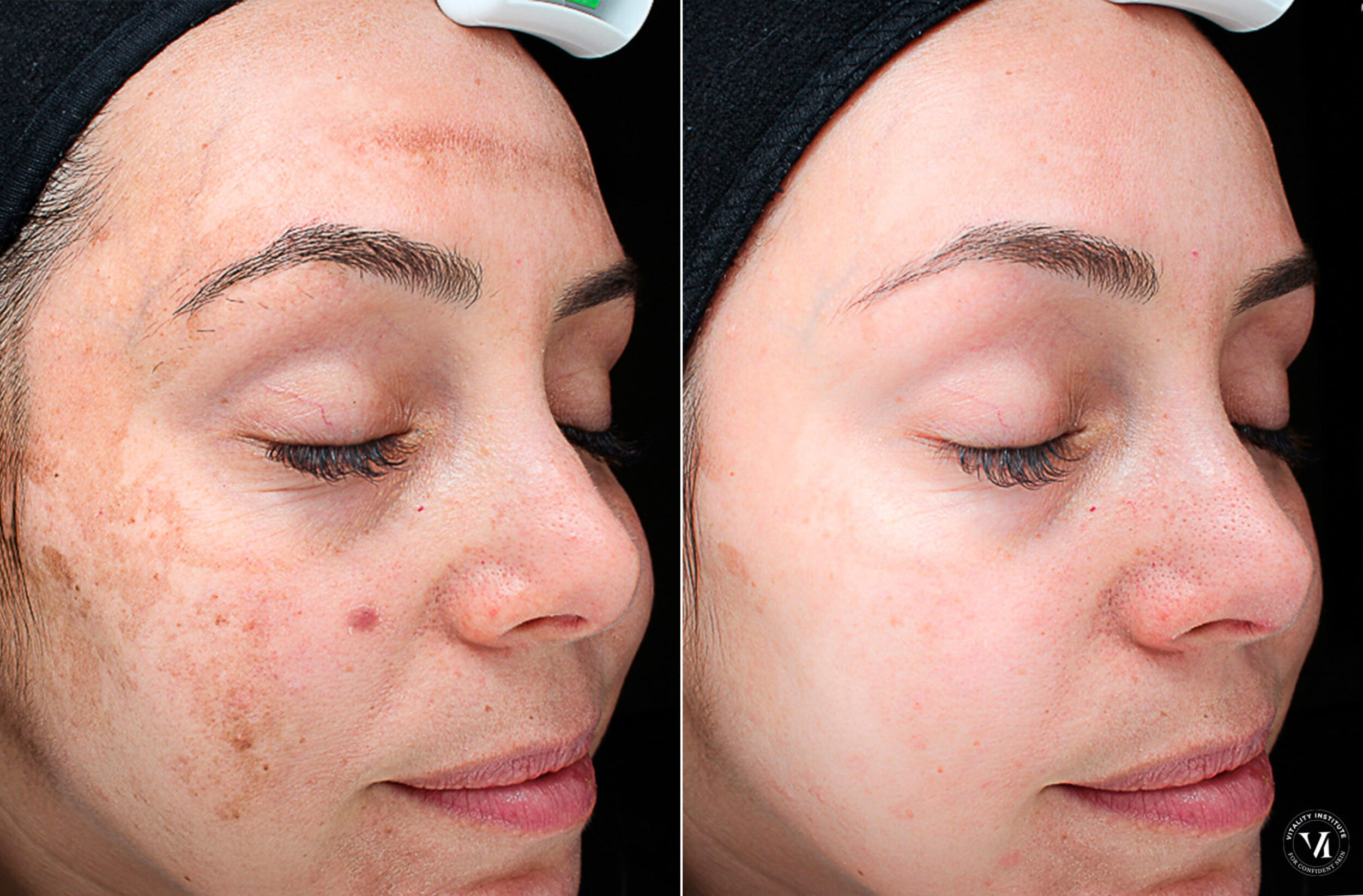 Before and After Image: Chemical Peels Before and After Photos in Houston, TX, Patient 10795 - right-front-oblique