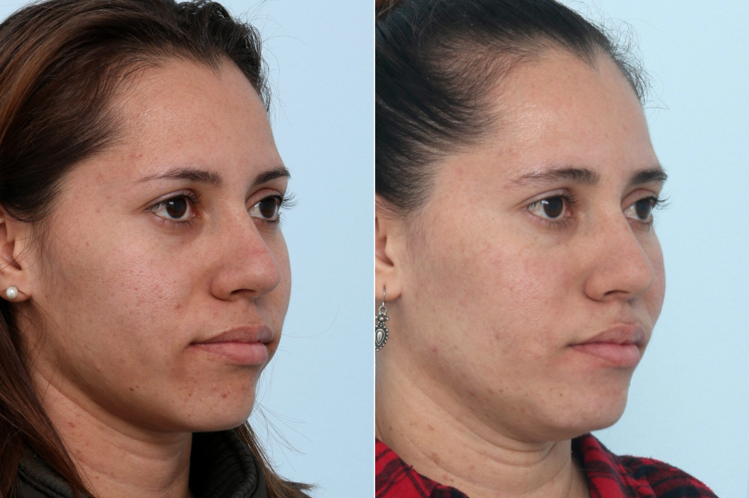 Before and After Image: Fraxel Laser Before and After Photos in Houston, TX, Patient 10837 - right-front-oblique