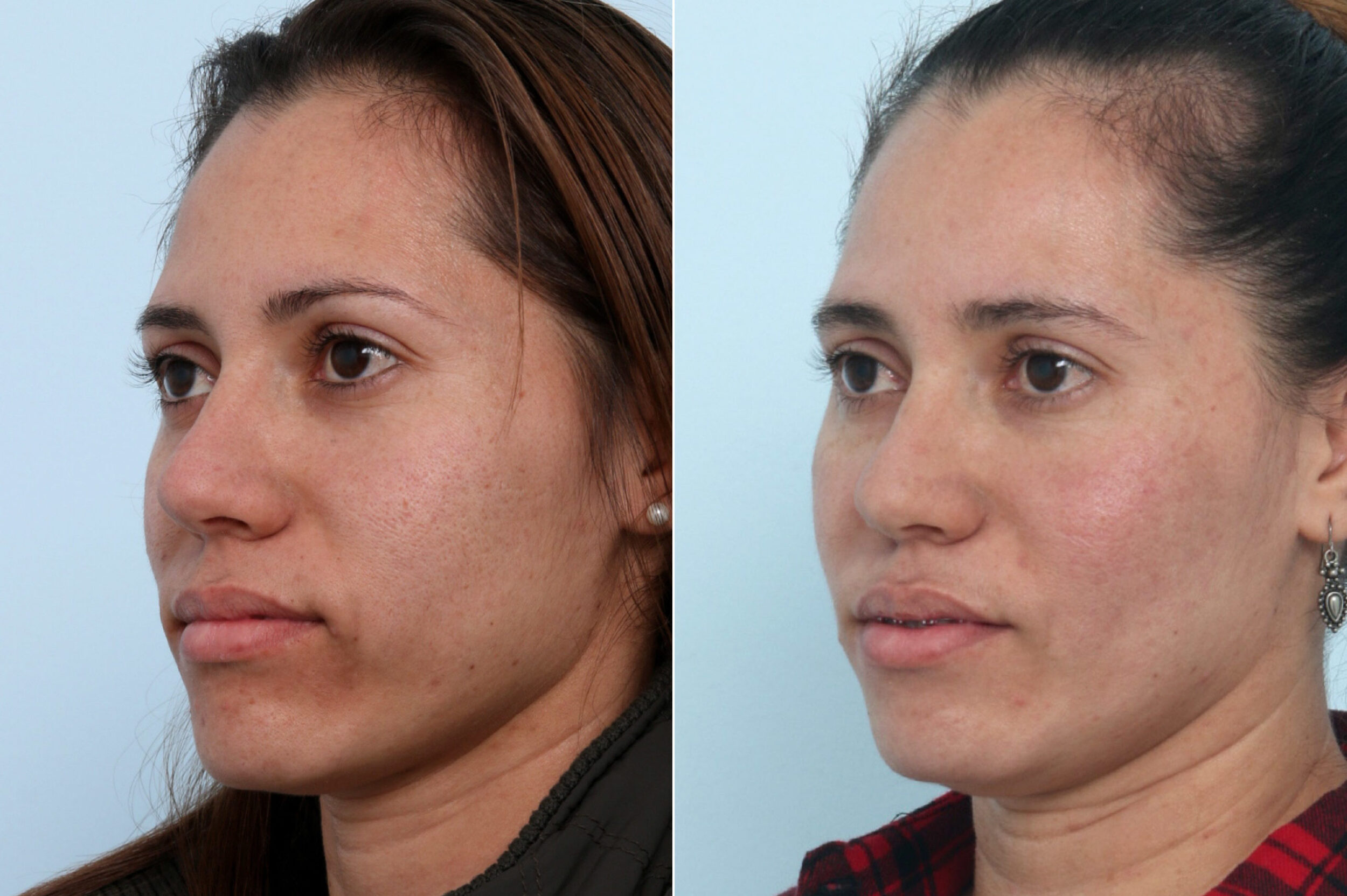 Before and After Image: Fraxel Laser Before and After Photos in Houston, TX, Patient 10837 - left-front-oblique