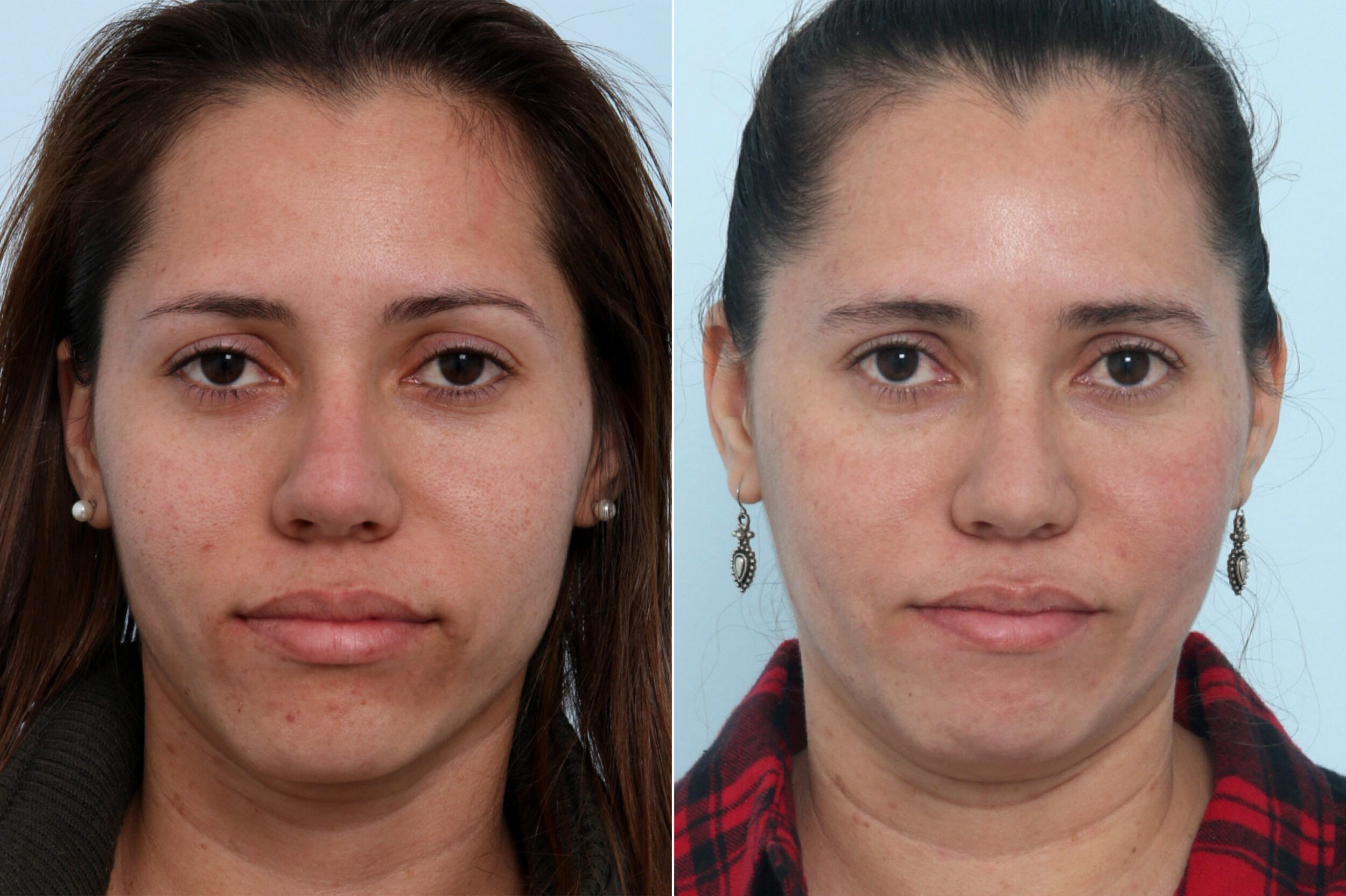 Before and After Image: Fraxel Laser Before and After Photos in Houston, TX, Patient 10837 - front