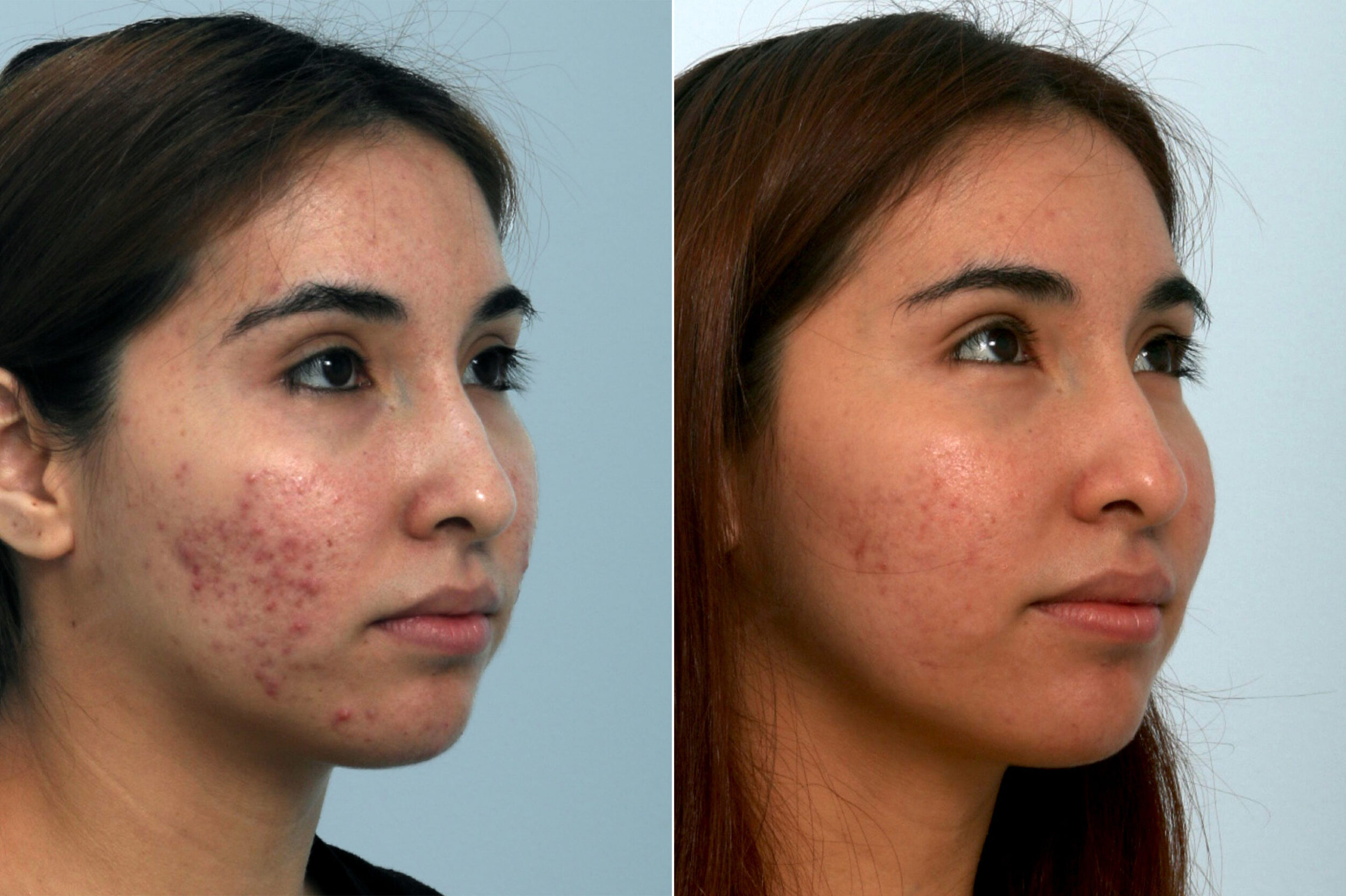 Before and After Image: Fraxel Laser Before and After Photos in Houston, TX, Patient 10943 - right-front-oblique