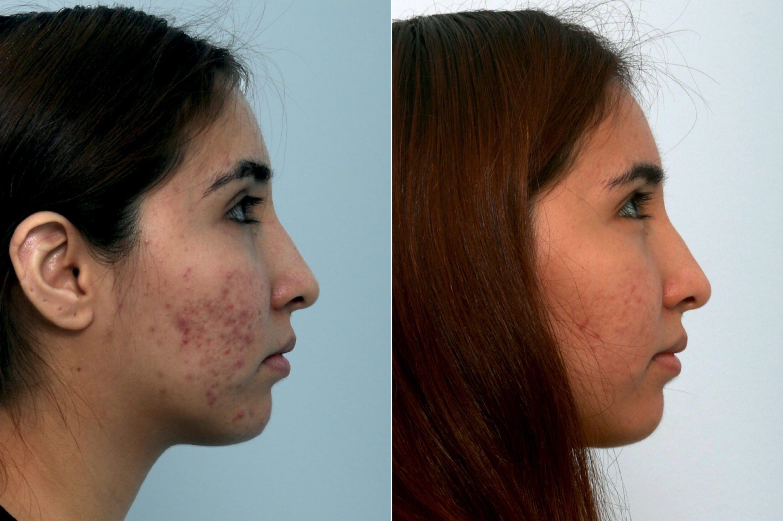 Before and After Image: Fraxel Laser Before and After Photos in Houston, TX, Patient 10943 - right-side