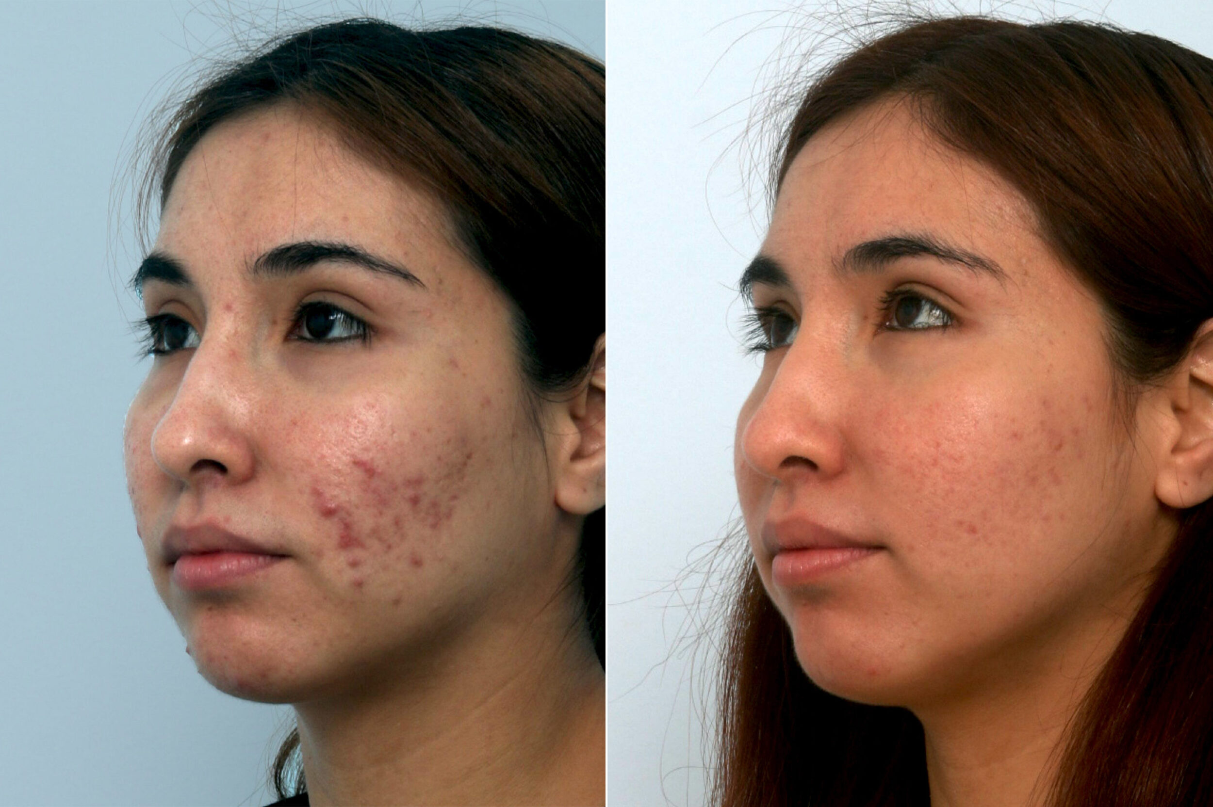 Before and After Image: Fraxel Laser Before and After Photos in Houston, TX, Patient 10943 - left-front-oblique