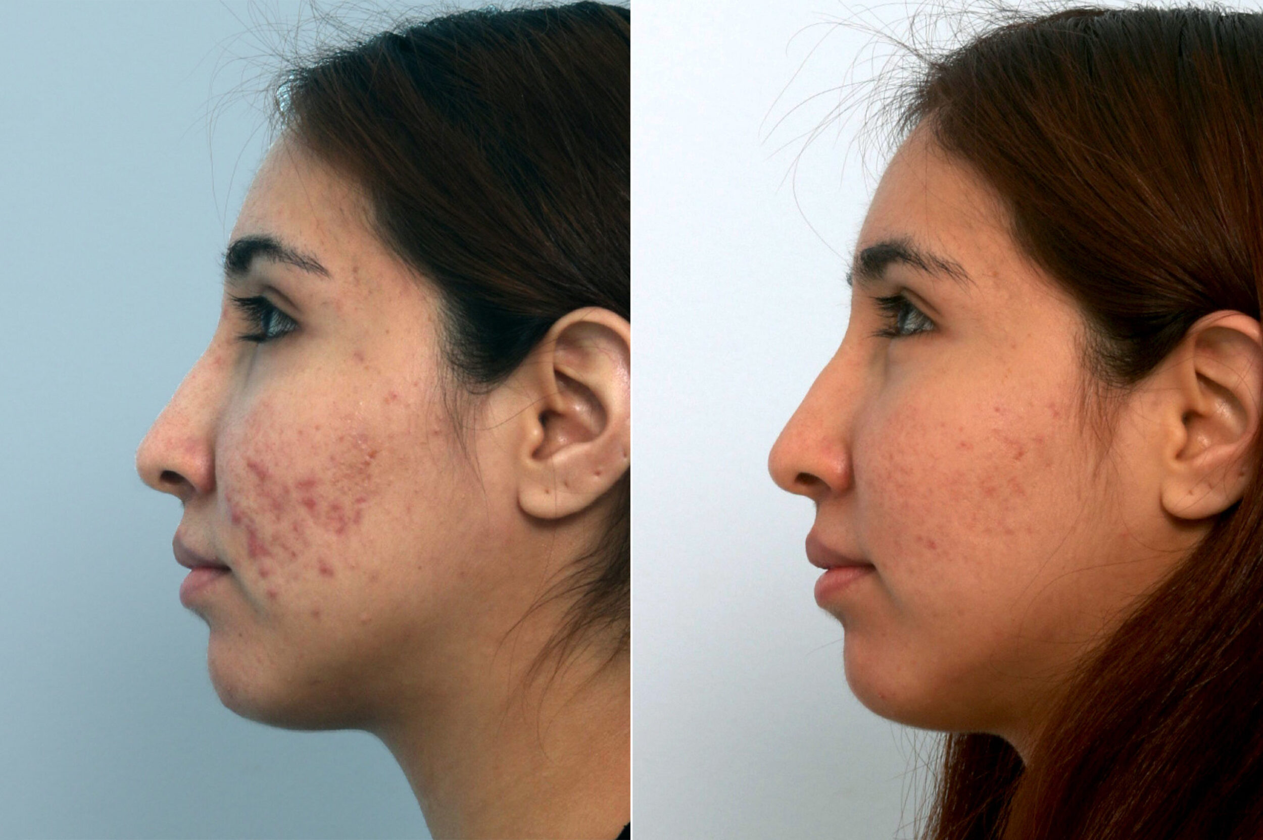 Before and After Image: Fraxel Laser Before and After Photos in Houston, TX, Patient 10943 - left-side