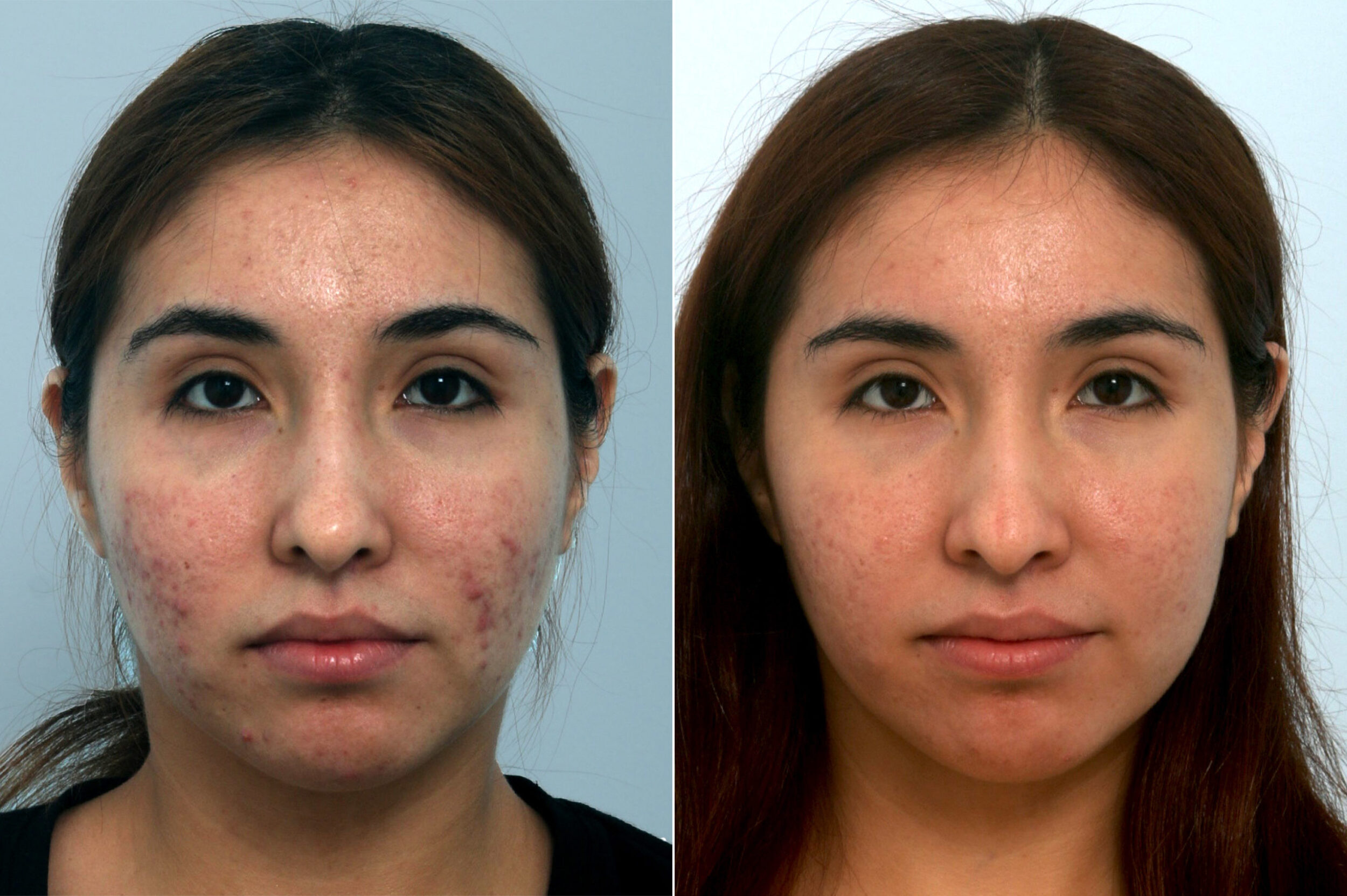 Before and After Image: Fraxel Laser Before and After Photos in Houston, TX, Patient 10943 - front