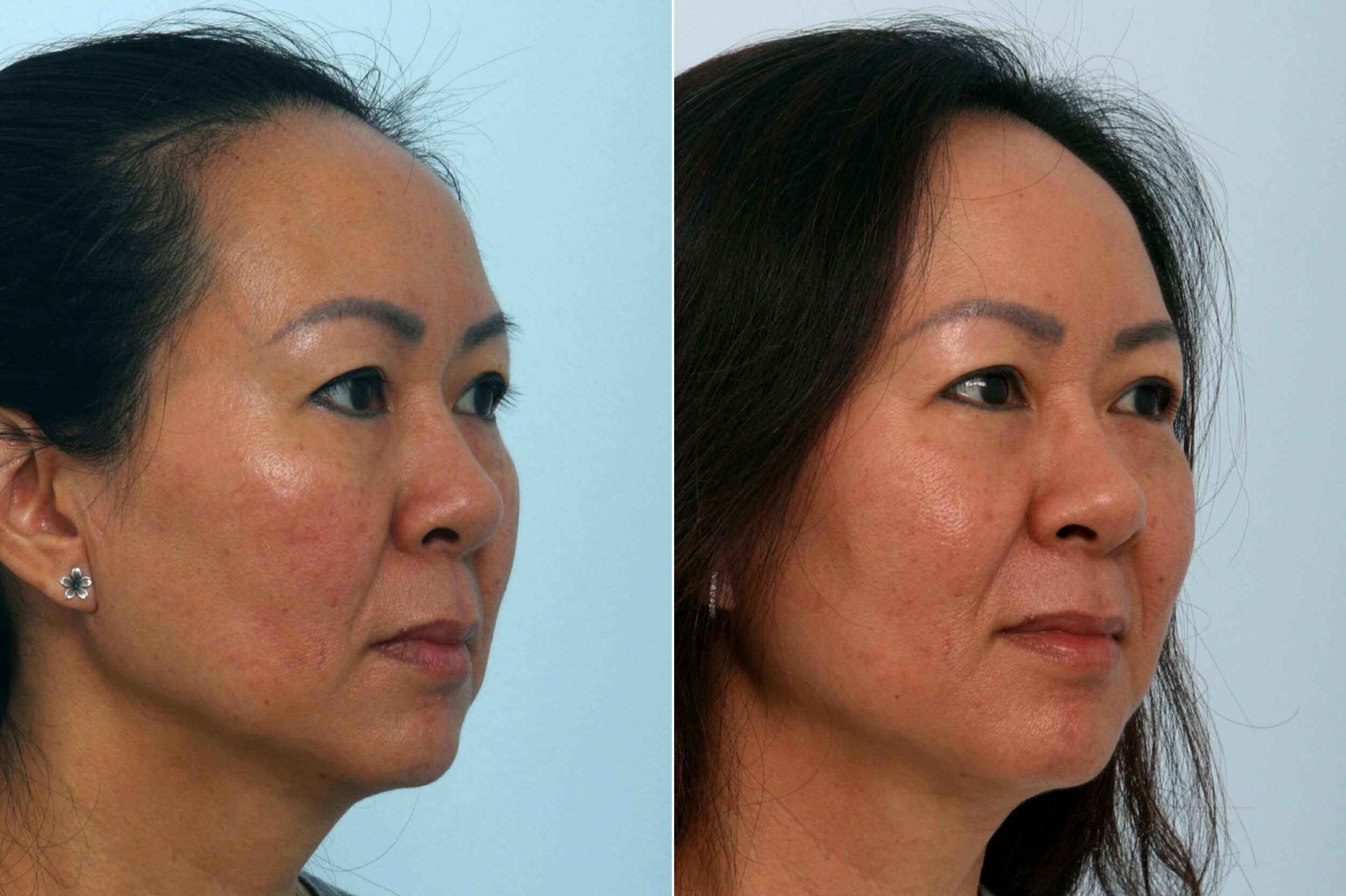 Before and After Image: Fraxel Laser Before and After Photos in Houston, TX, Patient 10961 - right-front-oblique