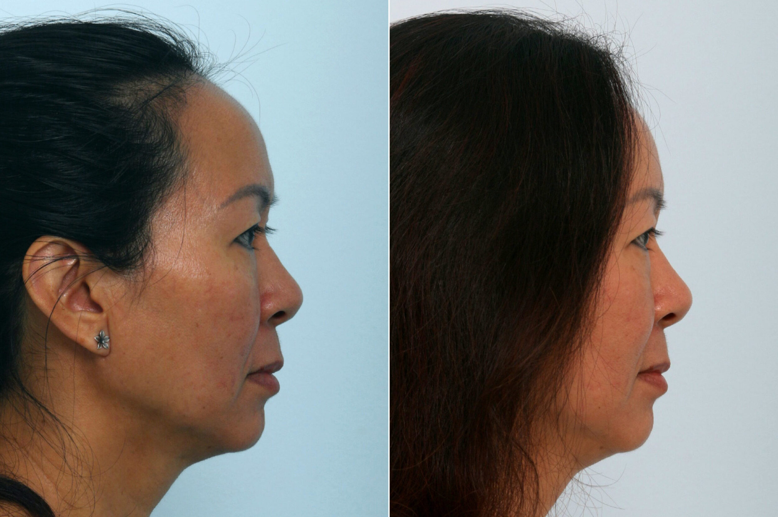 Before and After Image: Fraxel Laser Before and After Photos in Houston, TX, Patient 10961 - right-side