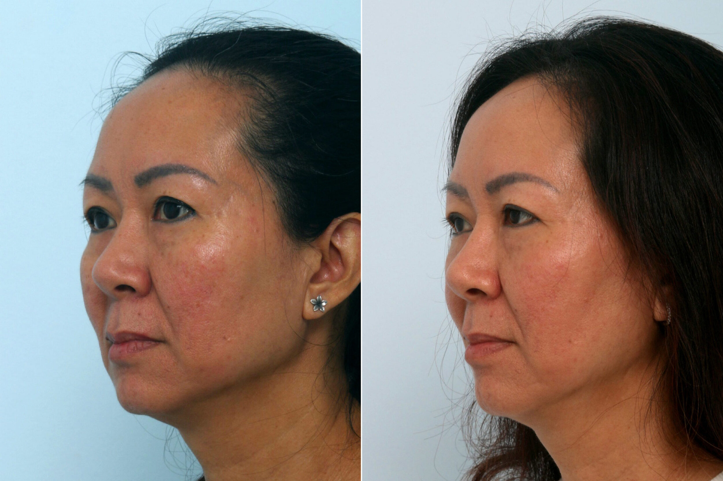 Before and After Image: Fraxel Laser Before and After Photos in Houston, TX, Patient 10961 - left-front-oblique