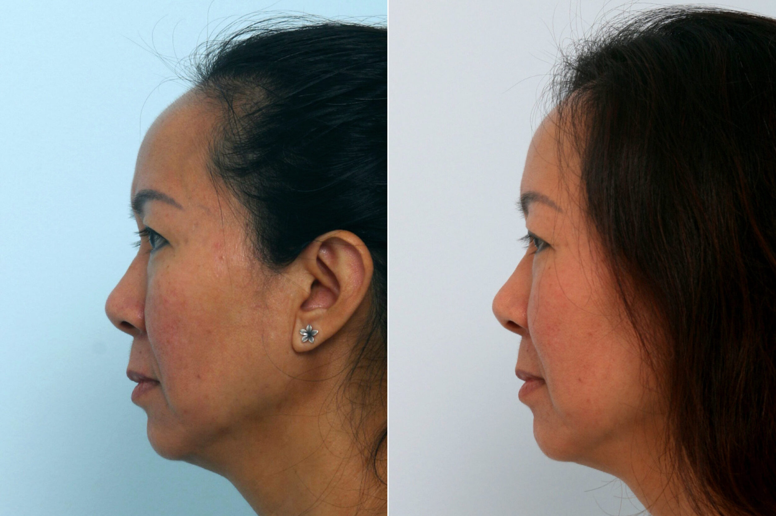 Before and After Image: Fraxel Laser Before and After Photos in Houston, TX, Patient 10961 - left-side
