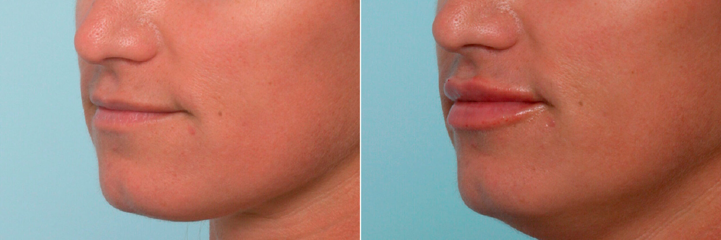 Before and After Image: Lip Enhancement Before and After Photos in Houston, TX, Patient 11384 - left-front-oblique