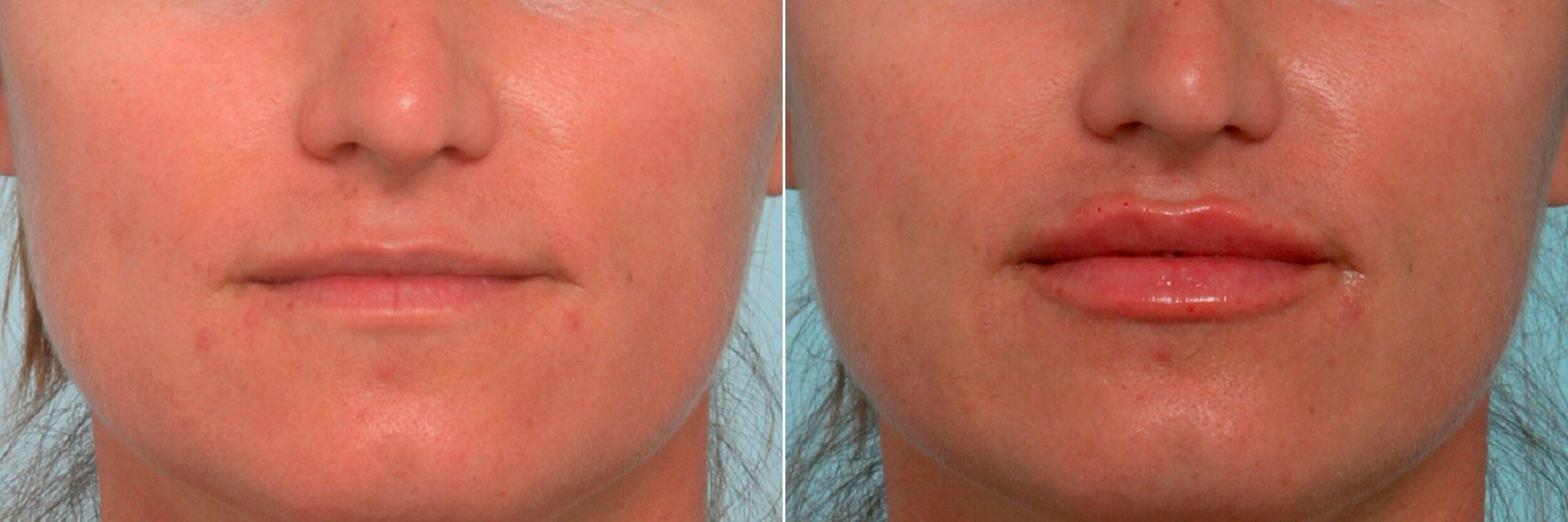 Before and After Image: Lip Enhancement Before and After Photos in Houston, TX, Patient 11384 - front