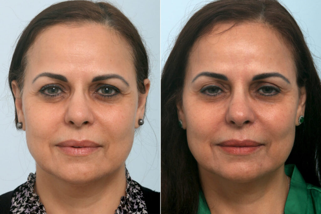patient 11408 ulthera lift before after 1200x799