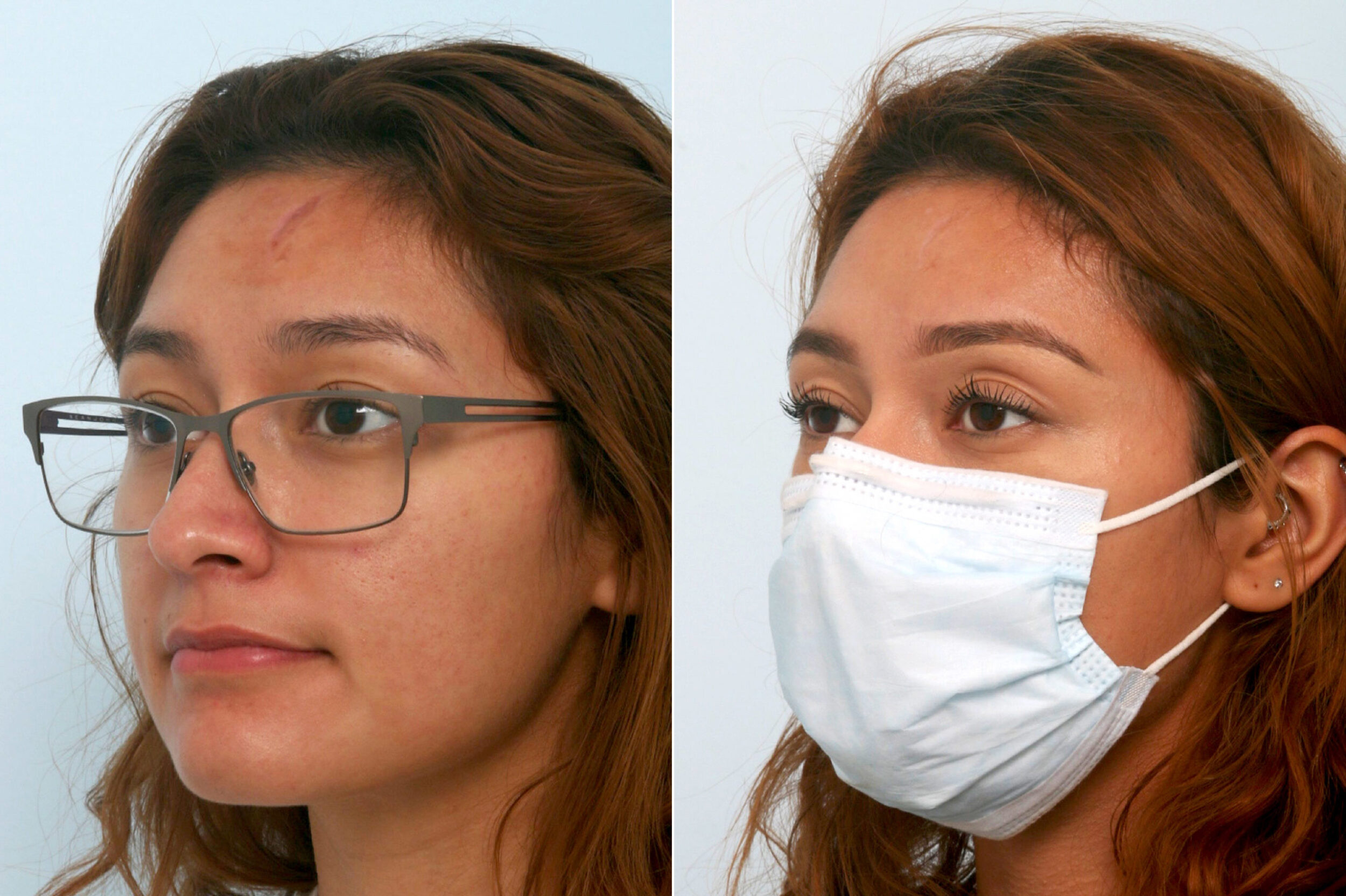Before and After Image: Fraxel Laser Before and After Photos in Houston, TX, Patient 11547 - left-front-oblique