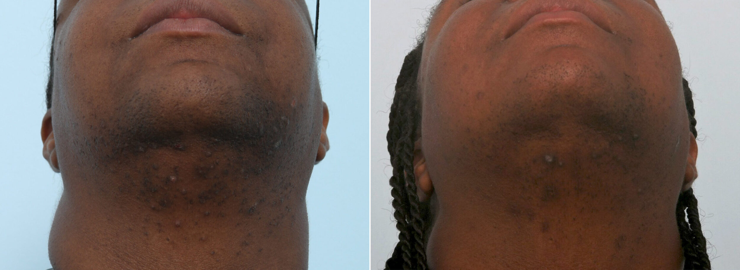Before and After Image: Laser Hair Removal Before and After Photos in Houston, TX, Patient 11565 - front