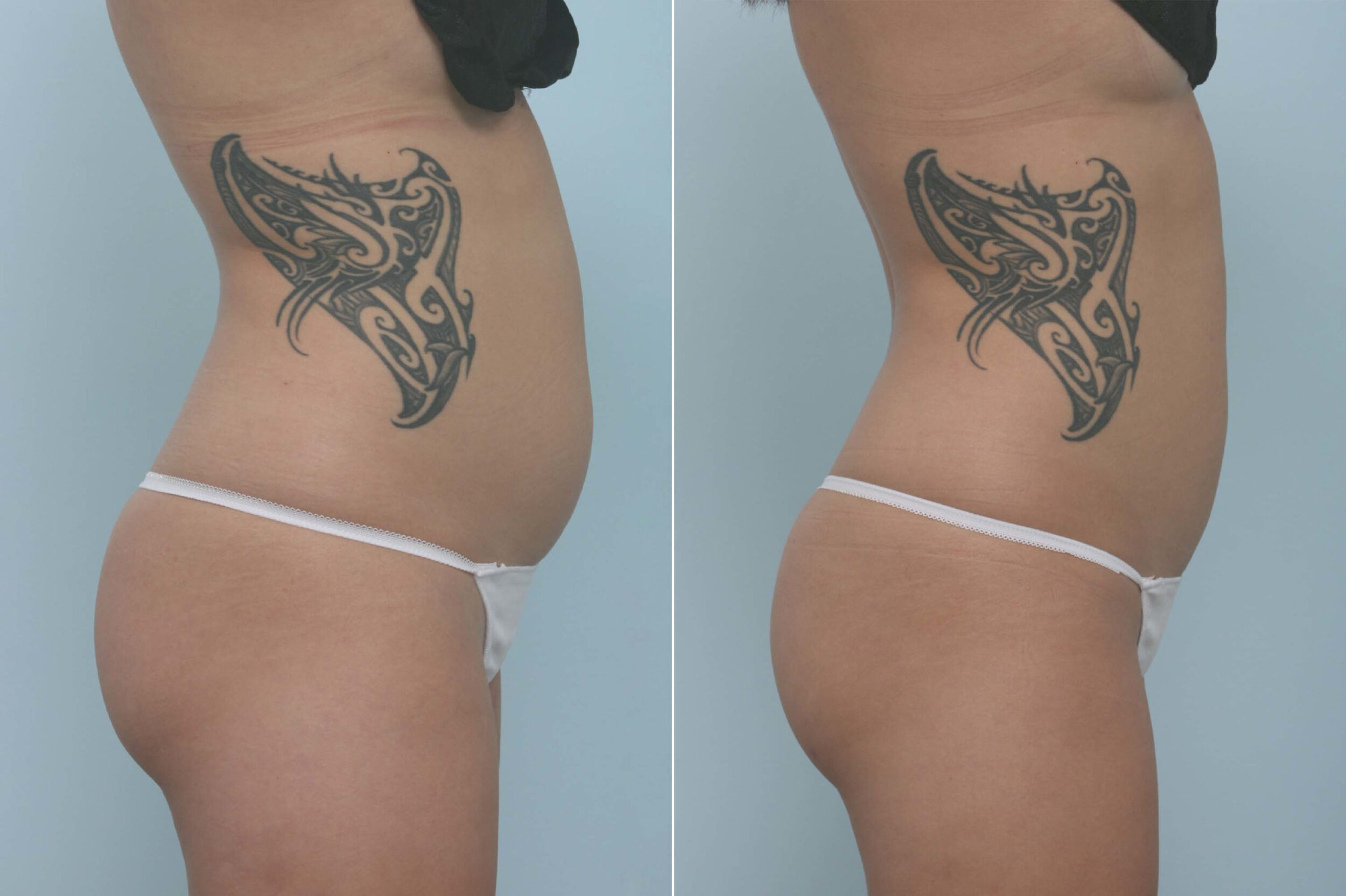 Before and After Image: CoolSculpting Before and After Photos in Houston, TX, Patient 11717 - right-side