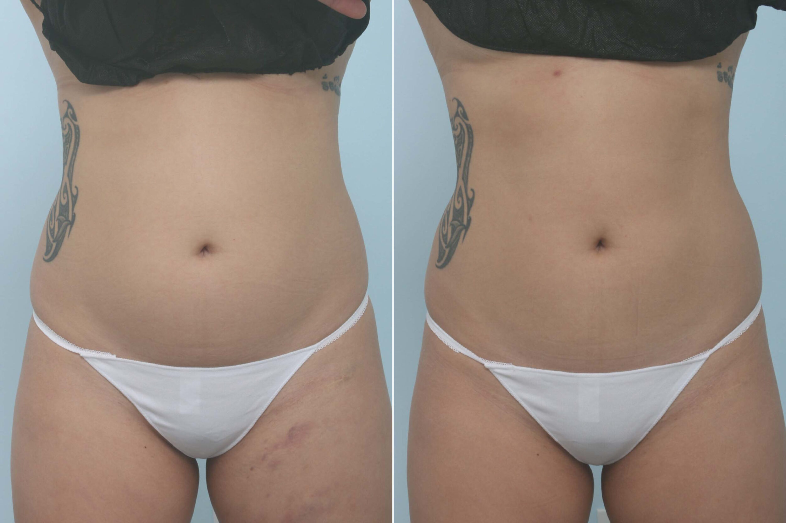 Before and After Image: CoolSculpting Before and After Photos in Houston, TX, Patient 11717 - front